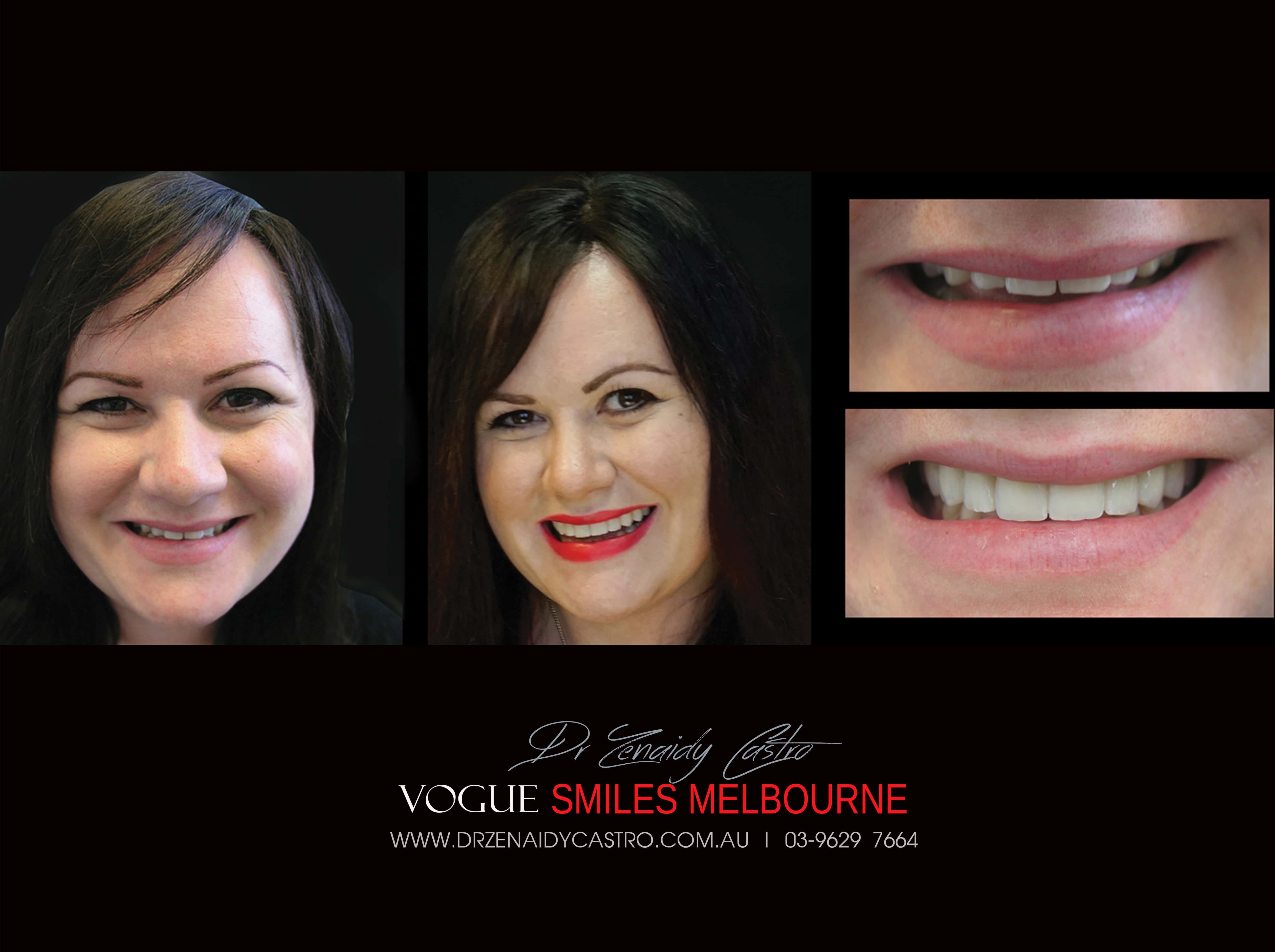 Fixing Short, Worn Down, Grinded down Teeth | Worn Teeth Treatment with Dental Veneers Melbourne CBD Cosmetic Dentistry