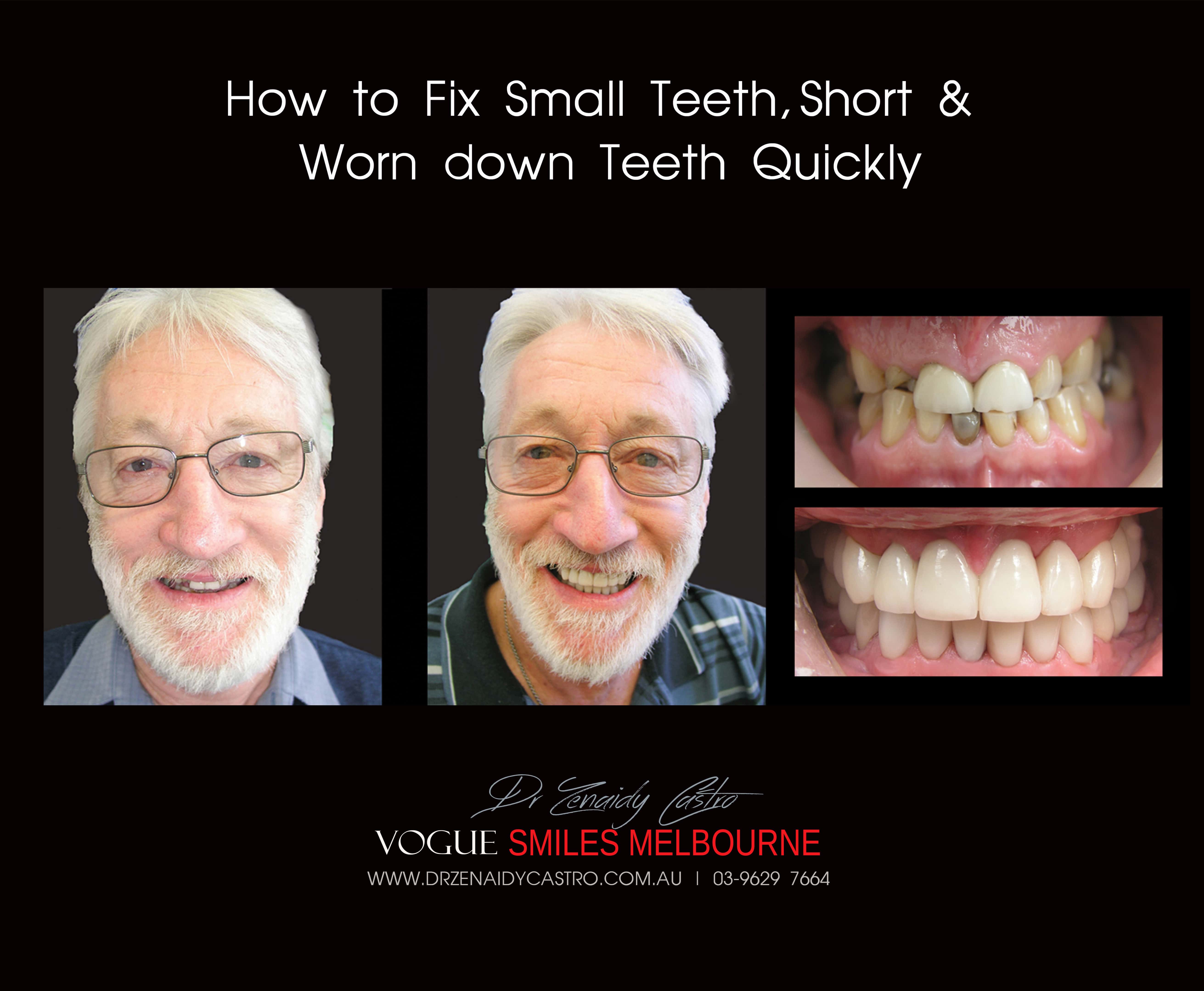 Short teeth, Worn-down, Grinded down teeth Treatment Melbourne CBD Cosmetic Dentist -Porcelain Veneer for worn down teeth