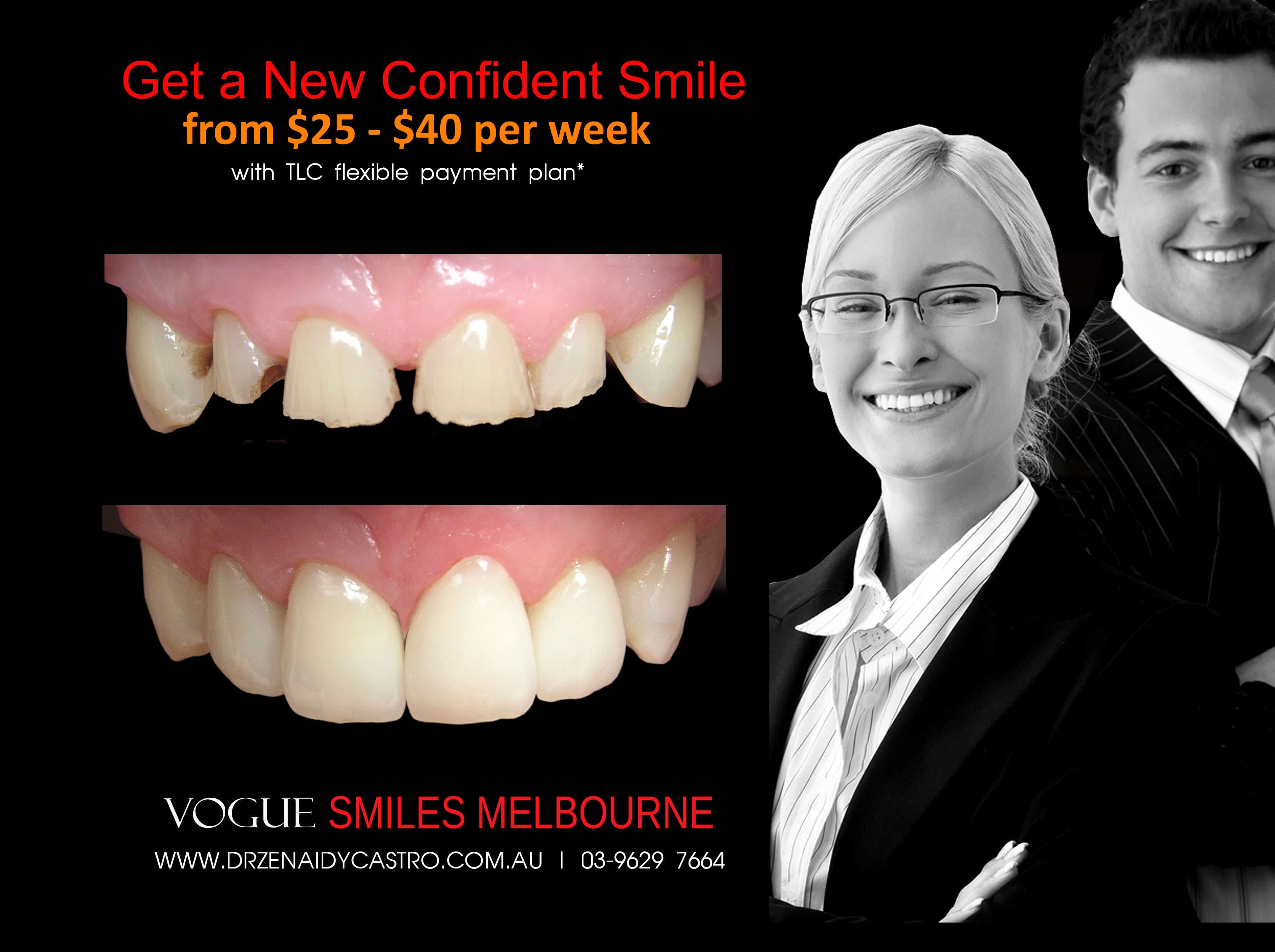 Short teeth, Worn-down, Grinded down teeth Treatment Melbourne CBD Cosmetic Dentist -Porcelain Veneer for worn down teeth