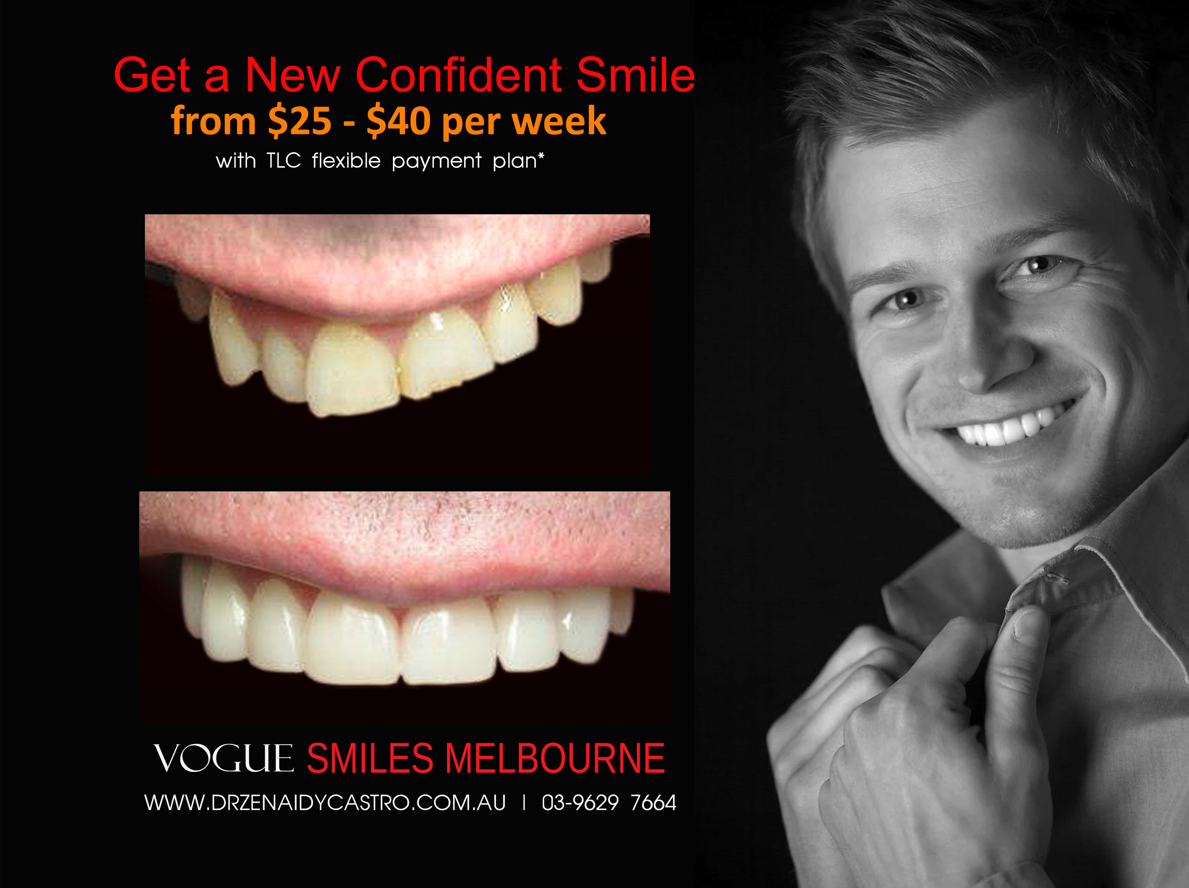 Short teeth, Worn-down, Grinded down teeth Treatment Melbourne CBD Cosmetic Dentist -Porcelain Veneer for worn down teeth