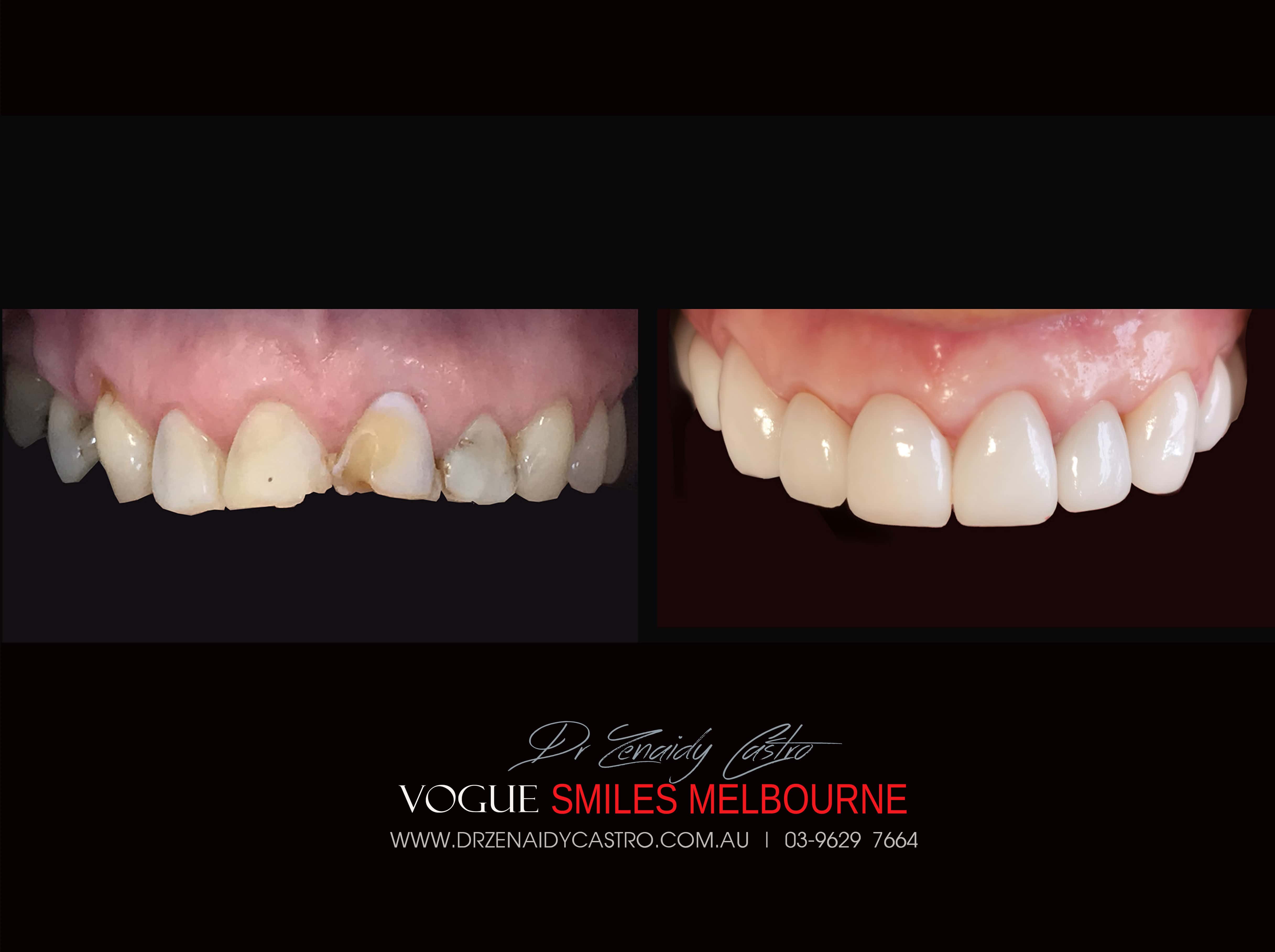 Short teeth, Worn-down, Grinded down teeth Treatment Melbourne CBD Cosmetic Dentist -Porcelain Veneer for worn down teeth