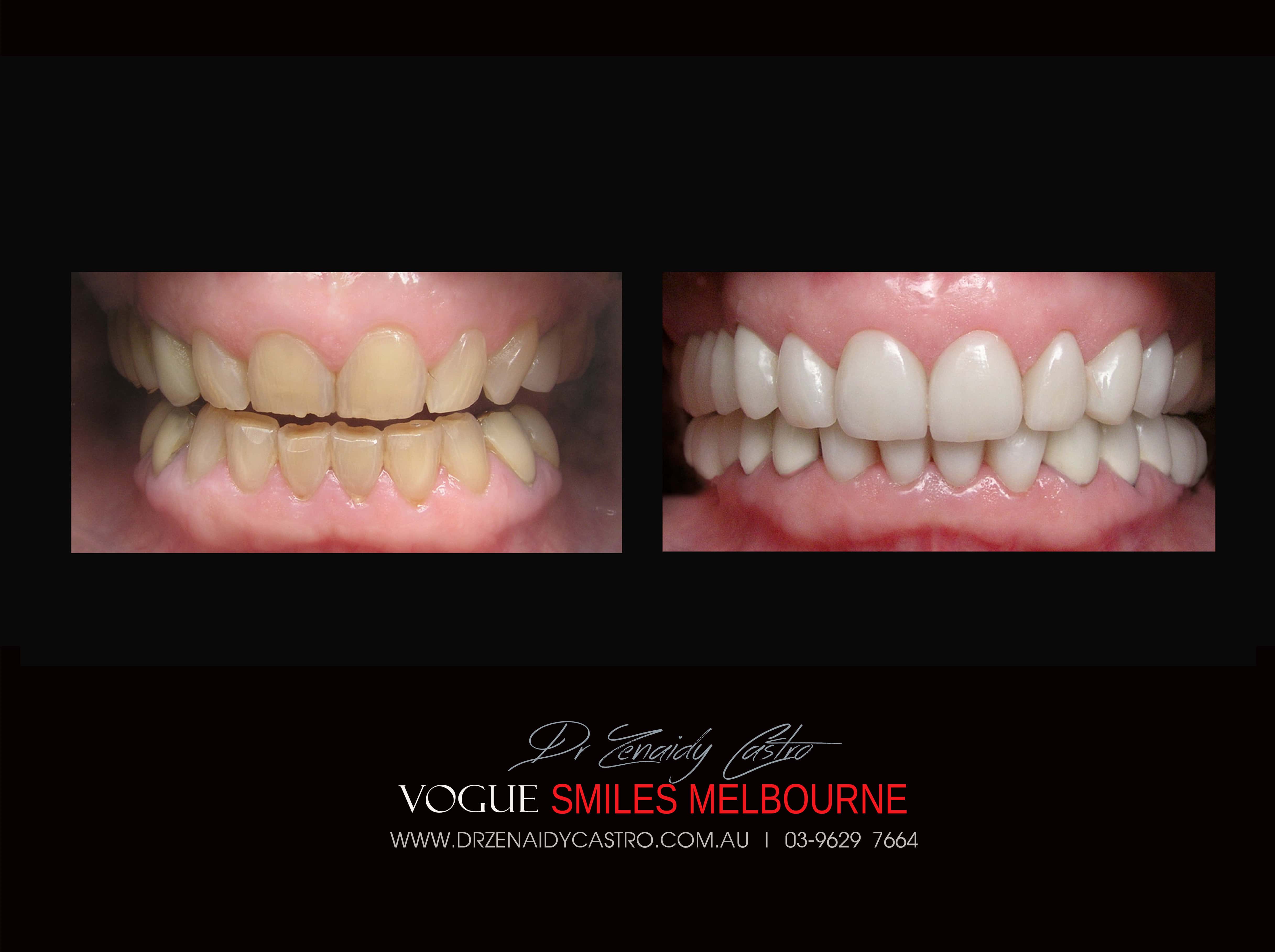 Short teeth, Worn-down, Grinded down teeth Treatment Melbourne CBD Cosmetic Dentist -Porcelain Veneer for worn down teeth