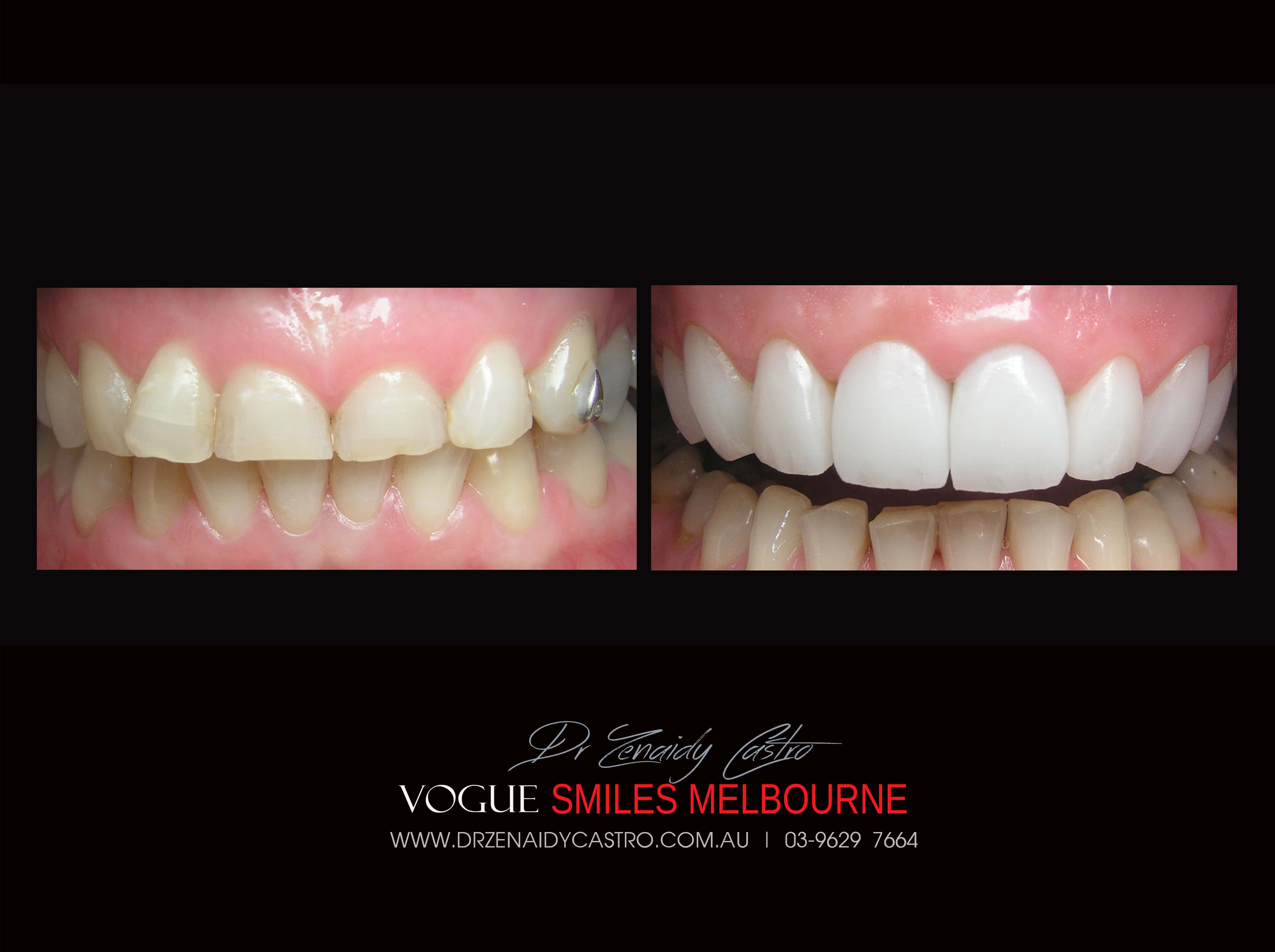 Short teeth, Worn-down, Grinded down teeth Treatment Melbourne CBD Cosmetic Dentist -Porcelain Veneer for worn down teeth