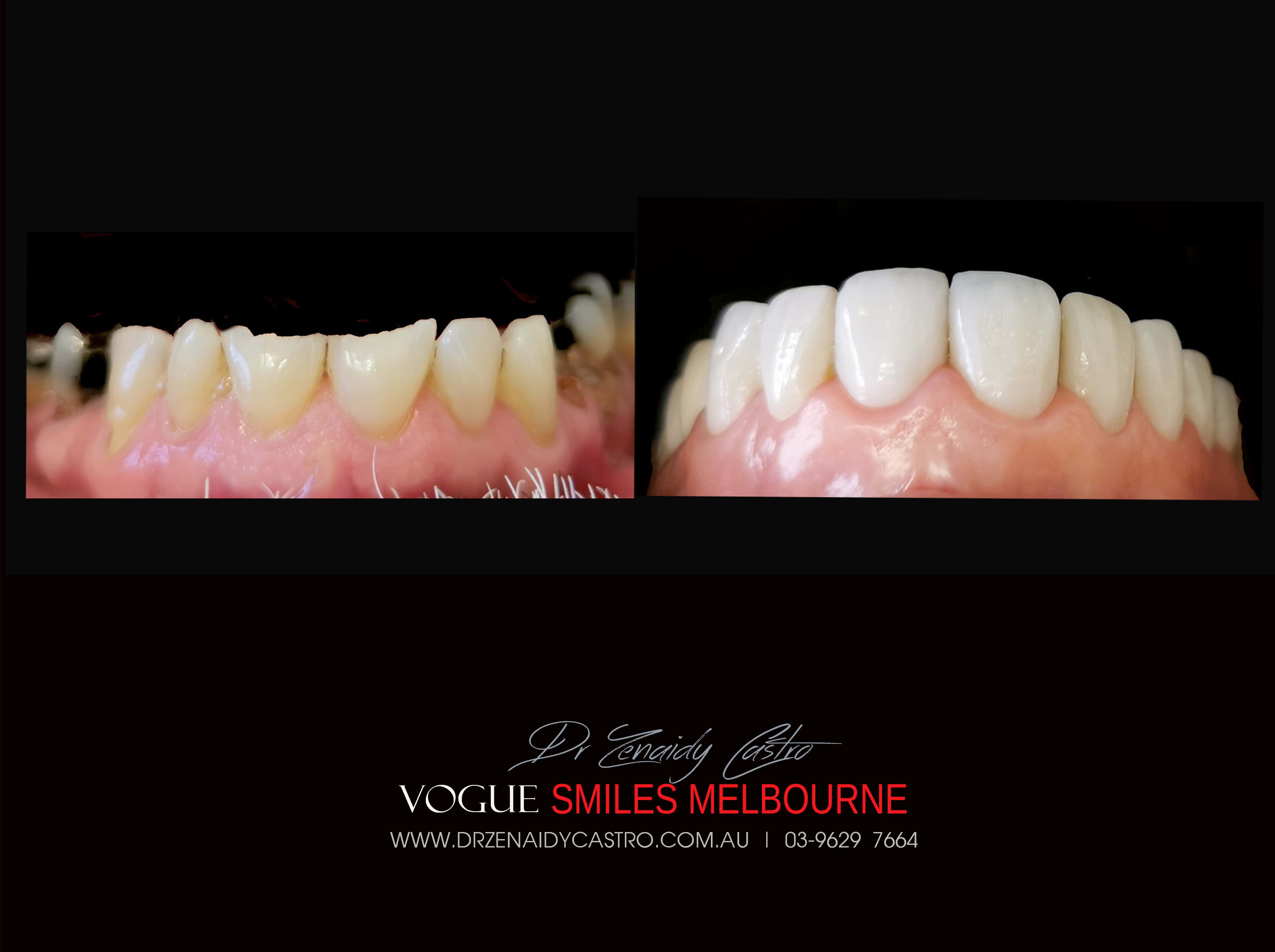 Fixing Short, Worn Down, Grinded down Teeth | Worn Teeth Treatment with Dental Veneers Melbourne CBD Cosmetic Dentistry