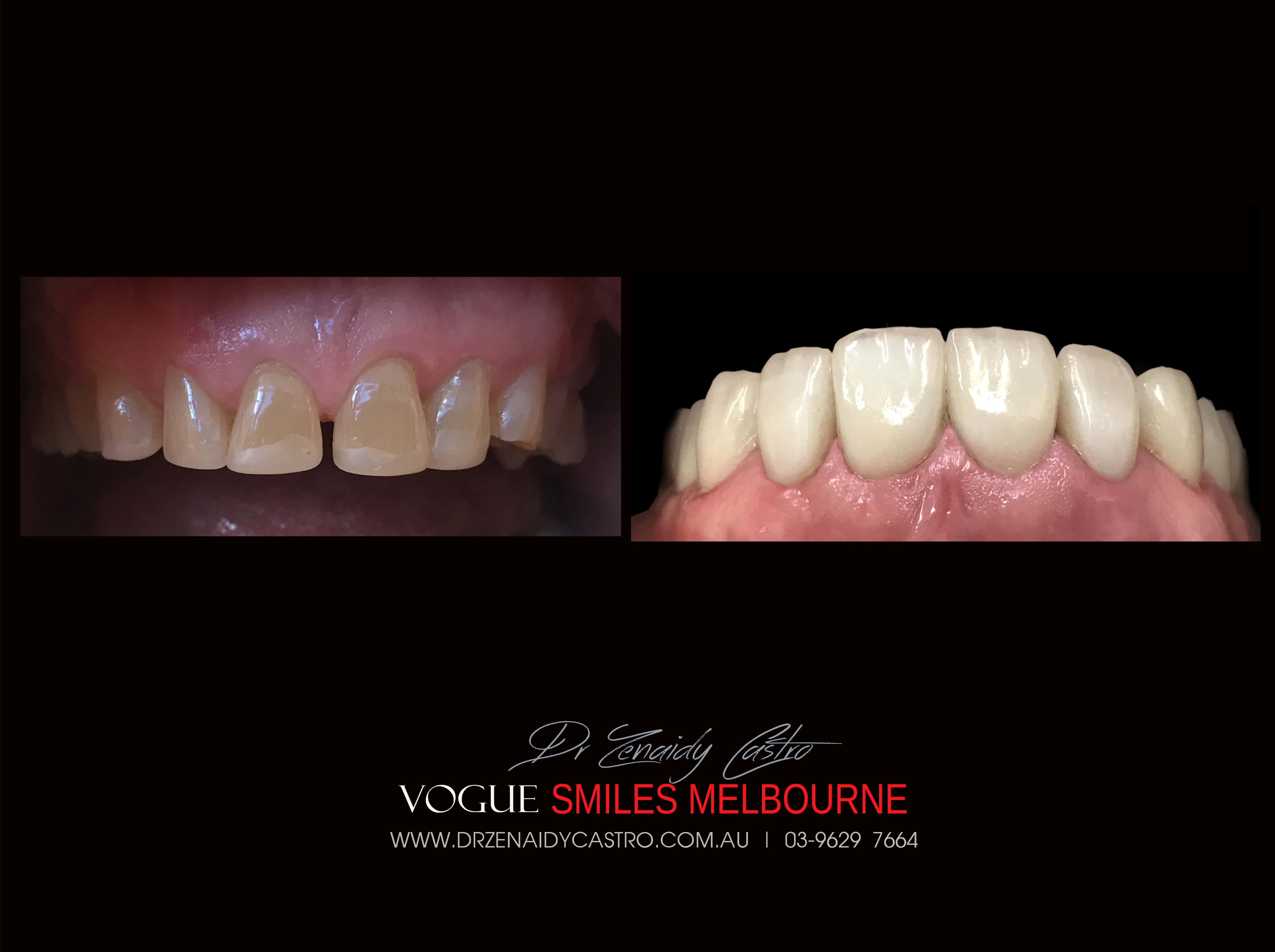 Short teeth, Worn-down, Grinded down teeth Treatment Melbourne CBD Cosmetic Dentist -Porcelain Veneer for worn down teeth