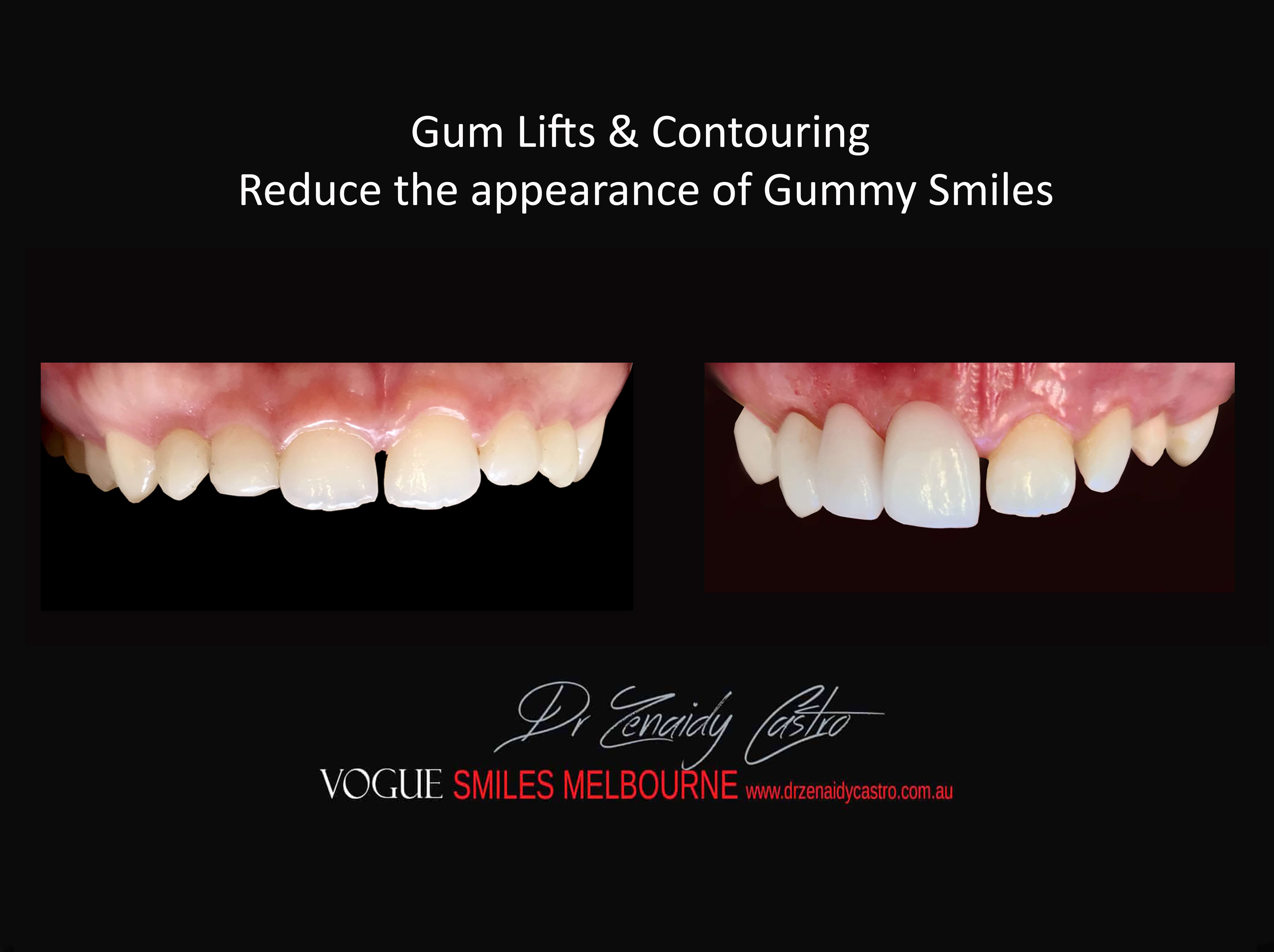 Gum Lifts, Gum Reshaping, Gum Contouring, Gum Recontouring, Gummy smile treatment, Crown lengthening, Tooth lengthening Melbourne CBD Victoria Australia 