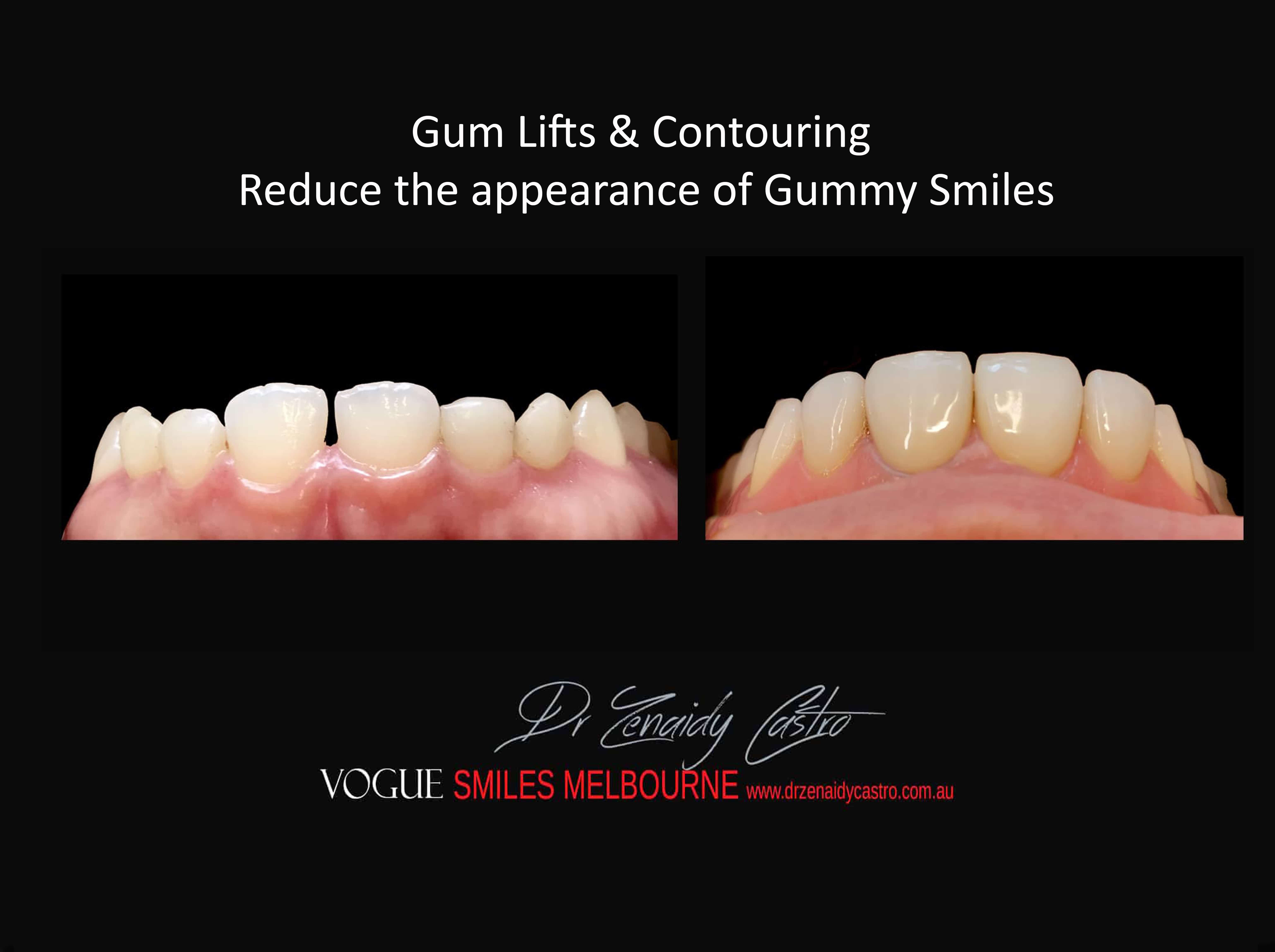 Gum Lifts, Gum Reshaping, Gum Contouring, Gum Recontouring, Gummy smile treatment, Crown lengthening, Tooth lengthening Melbourne CBD Victoria Australia 