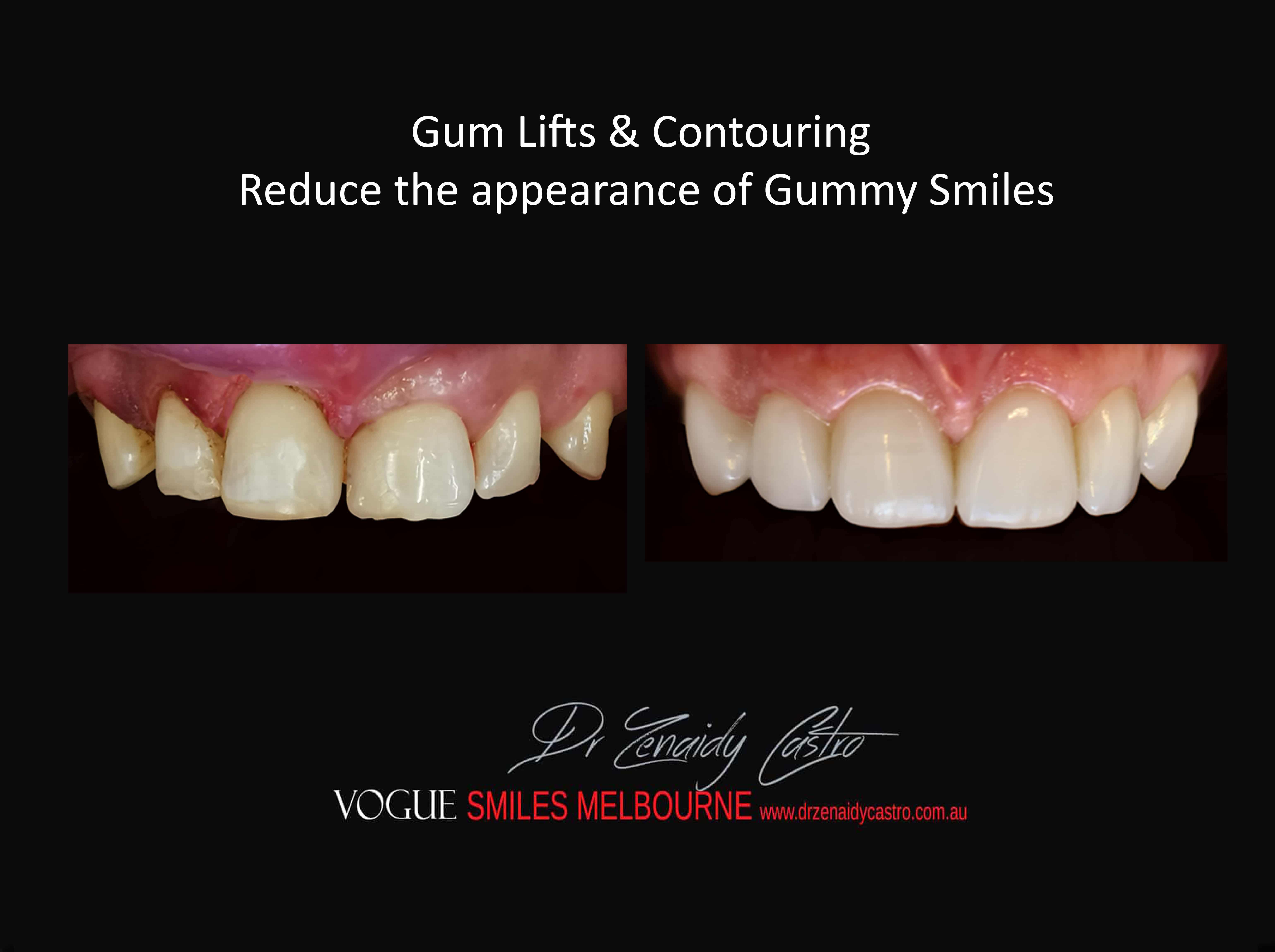 Gum Lifts, Gum Reshaping, Gum Contouring, Gum Recontouring, Gummy smile treatment, Crown lengthening, Tooth lengthening Melbourne CBD Victoria Australia 