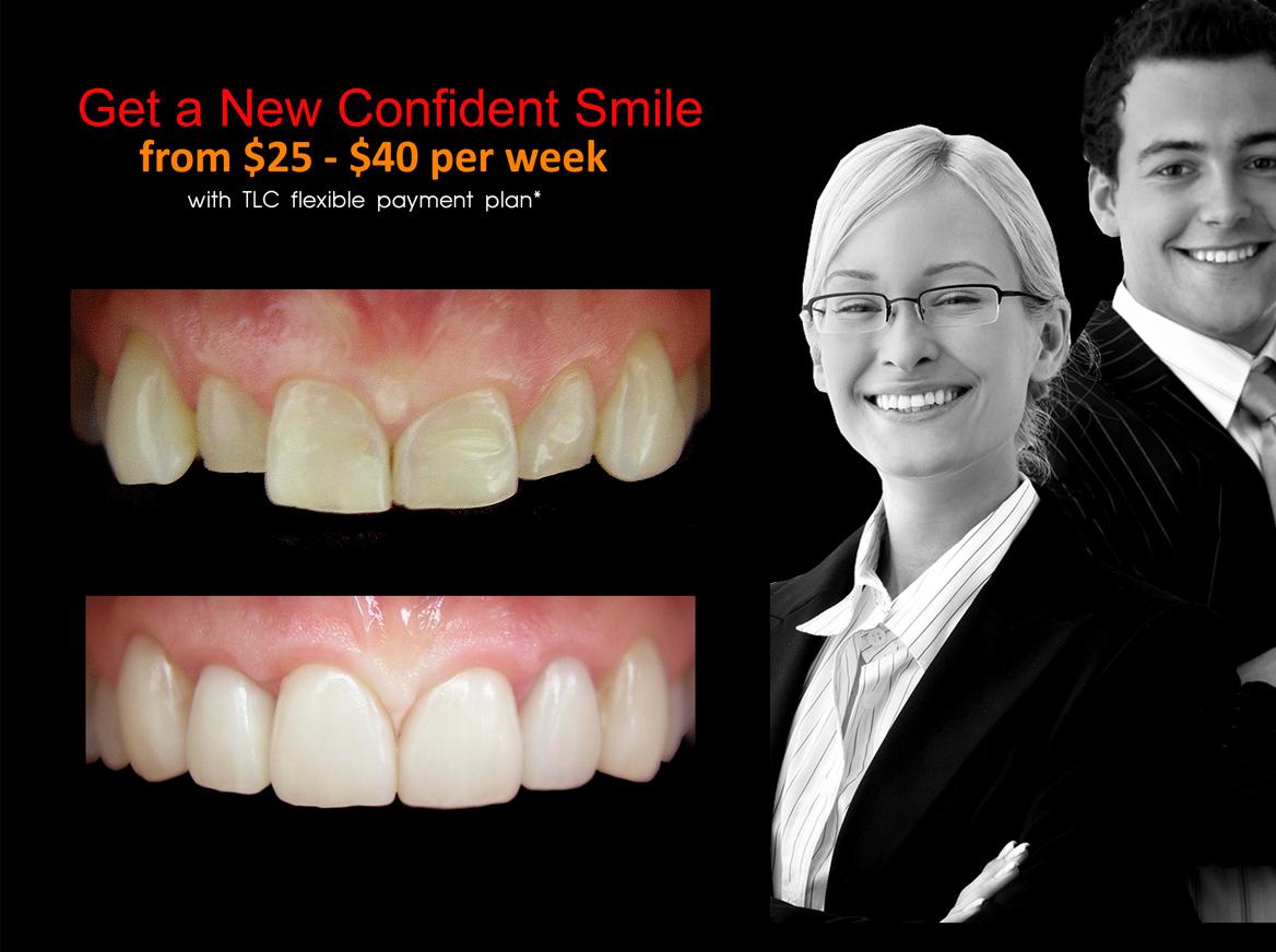 Composite Bonding resin veneers Melbourne CBD- Cosmetic Dentist Melbourne