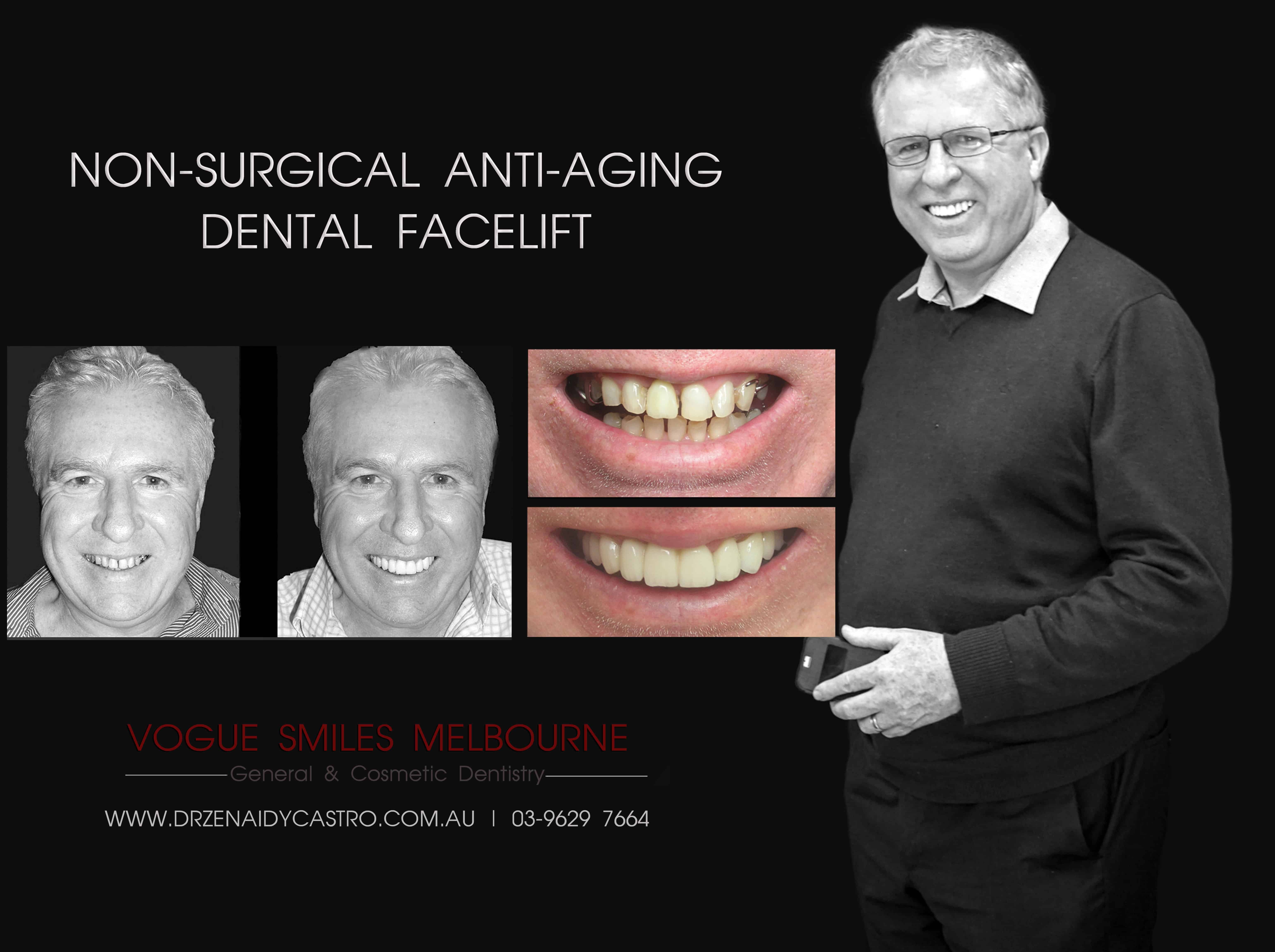 Smile Rejuvenation by Vogue Smiles Melbourne, rejuvenation clinic Melbourne, Non-surgical Facial Rejuvenation Melbourne, Anti Aging Treatment Melbourne