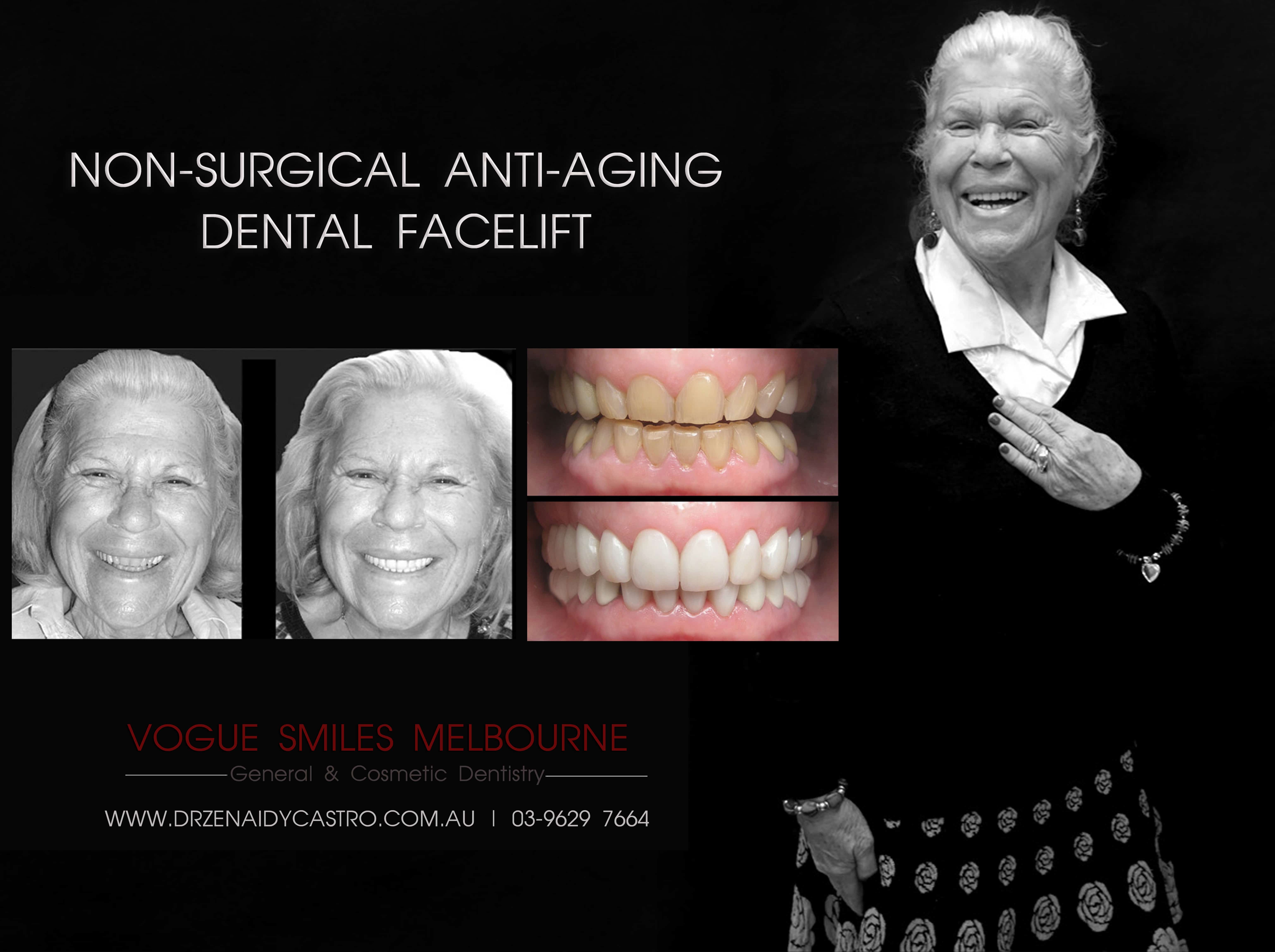 Non-surgical facelift procedure with Dental Veneers Melbourne CBD -Anti-aging expert Melbourne CBD, Non-Surgical & Minimally Invasive Facial and Smile Rejuvenation Melbourne