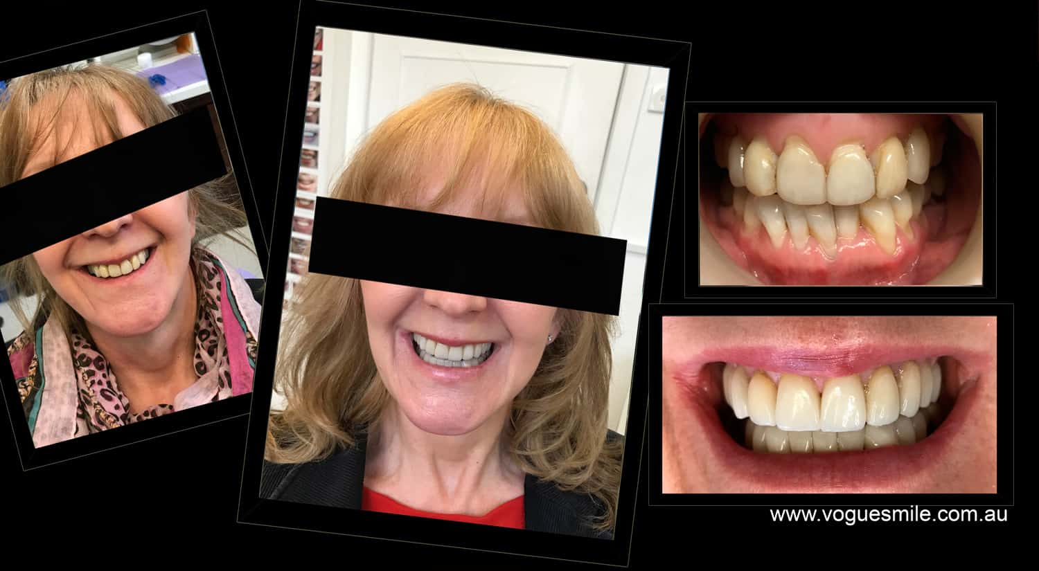 Narrow Smiles - How We Can Broaden for Fuller, Wider Smiles -COSMETIC DENTIST MELBOURNE CBD-PORCELAIN VENEERS MELBOURNE CBD