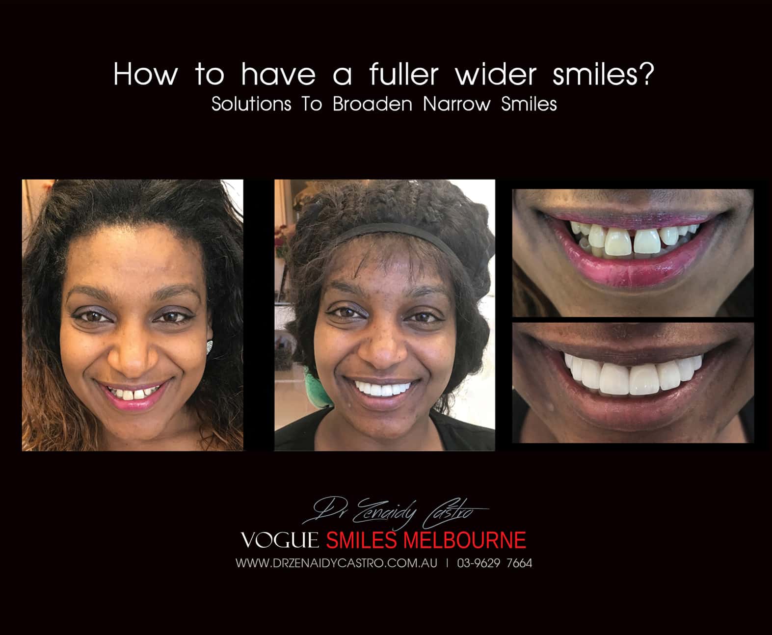 Narrow Smiles - How We Can Broaden for Fuller, Wider Smiles -COSMETIC DENTIST MELBOURNE CBD-PORCELAIN VENEERS MELBOURNE CBD