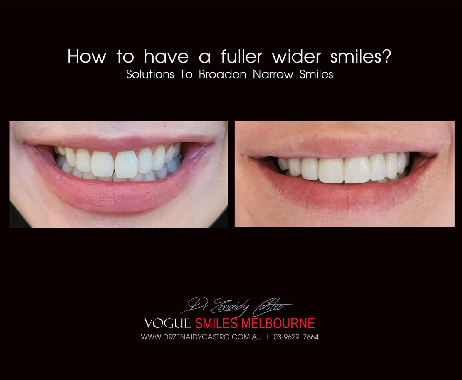 N0-PREP Porcelain Veneers - Dental Veneers without grinding teeth Melbourne