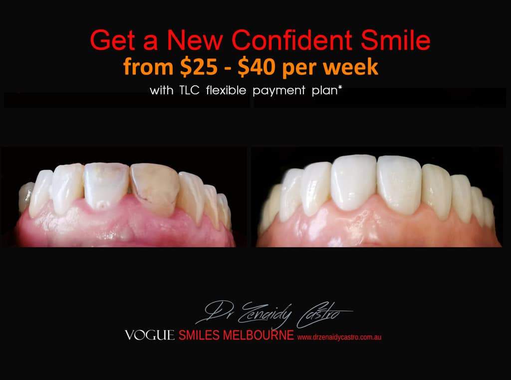 Narrow Smiles - How We Can Broaden for Fuller, Wider Smiles -COSMETIC DENTIST MELBOURNE CBD-PORCELAIN VENEERS MELBOURNE CBD