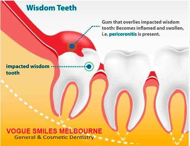 Inflamed, Swollen gums around third molar area - PERICORONITIS Treatment Melbourne CBD, pericoronitis treatment, pericoronitis treatment at home, how long does pericoronitis last, pericoronitis pain unbearable, can pericoronitis kill you, does pericoronitis go away, pericoronitis symptoms, pericoronitis antibiotics,