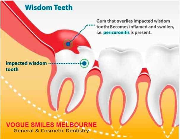 PERICORONITIS INFLAMED GUMS BEHIND MOLAR, SWOLLEN GUMS