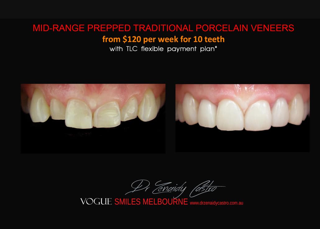 Composite Bonding resin veneers Melbourne CBD- Cosmetic Dentist Melbourne