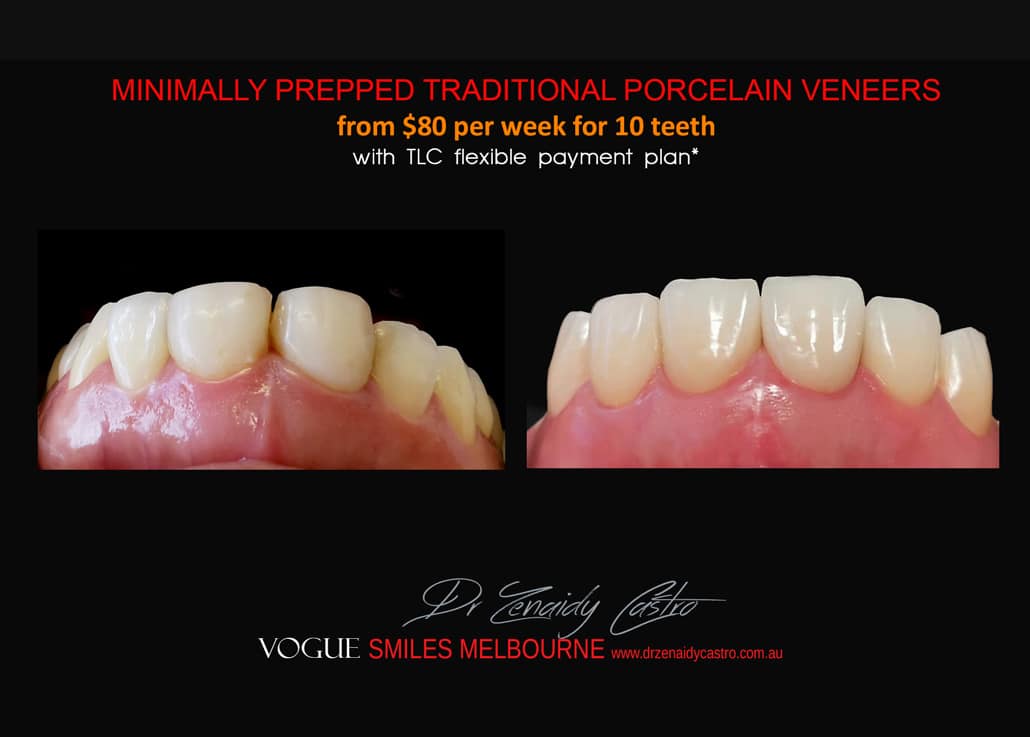 Composite Bonding resin veneers Melbourne CBD- Cosmetic Dentist Melbourne