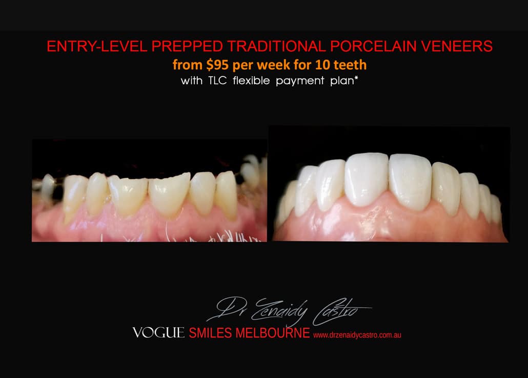 Composite Bonding resin veneers Melbourne CBD- Cosmetic Dentist Melbourne