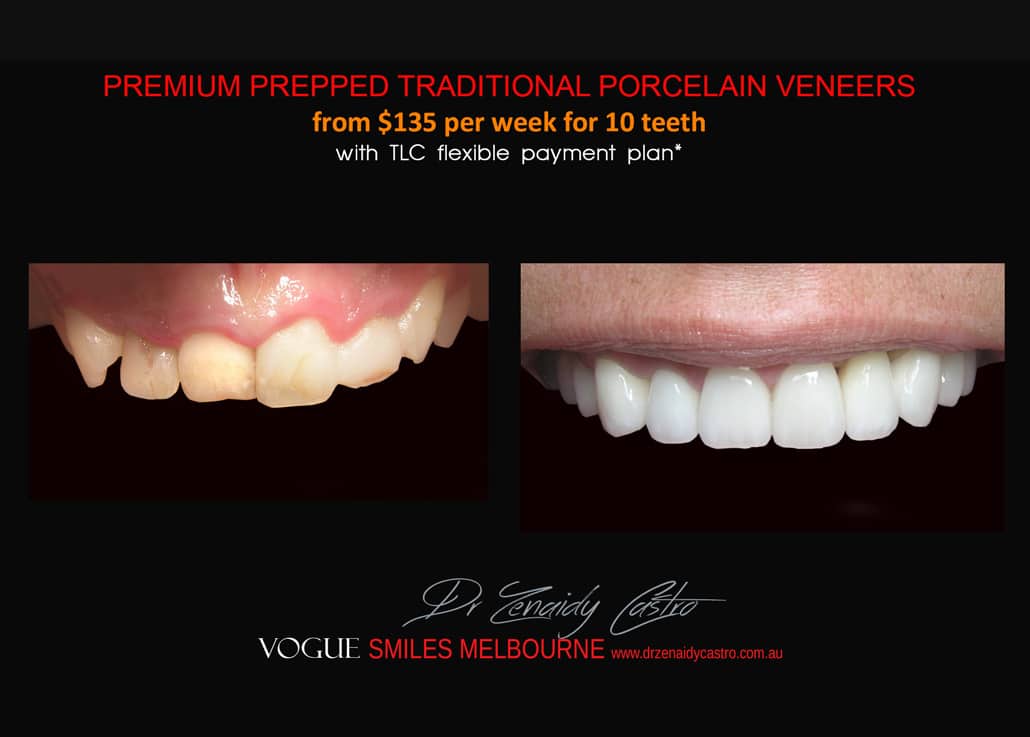 Composite Bonding resin veneers Melbourne CBD- Cosmetic Dentist Melbourne