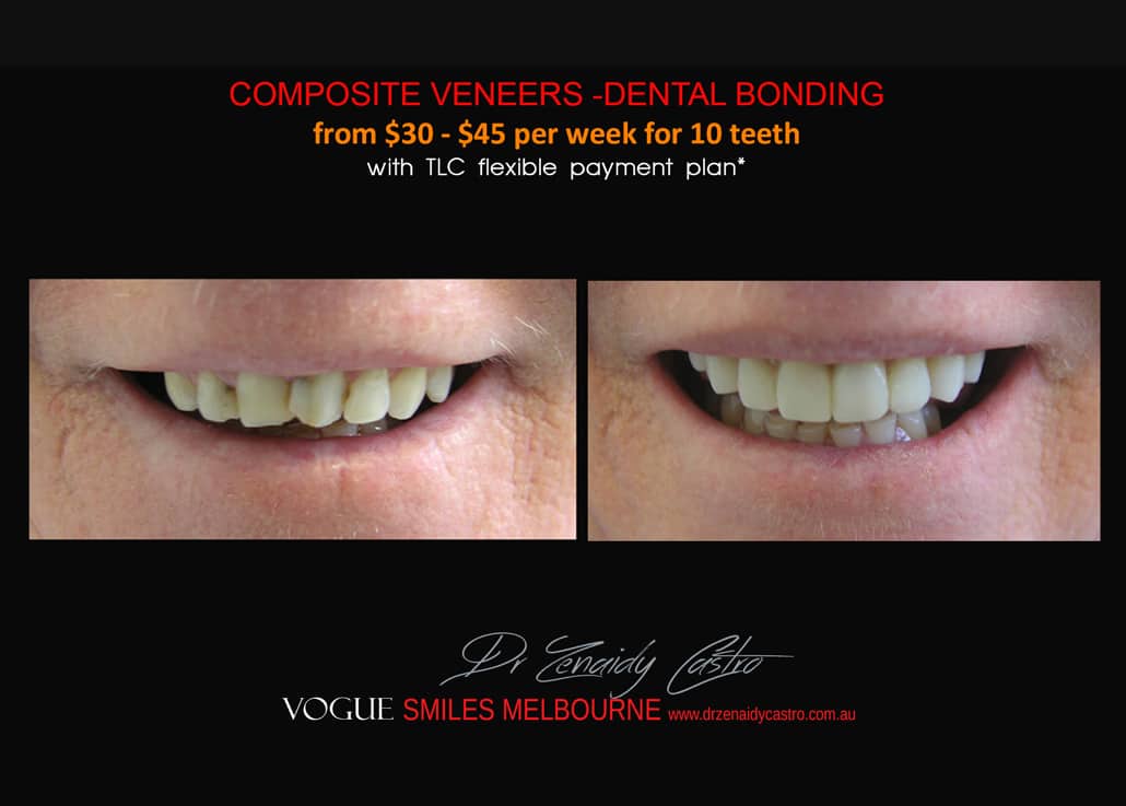 FULL SETS OF PORCELAIN VENEER COST PRICE IN MELBOURNE CBD - COSMETIC DENTIST COST VENEER