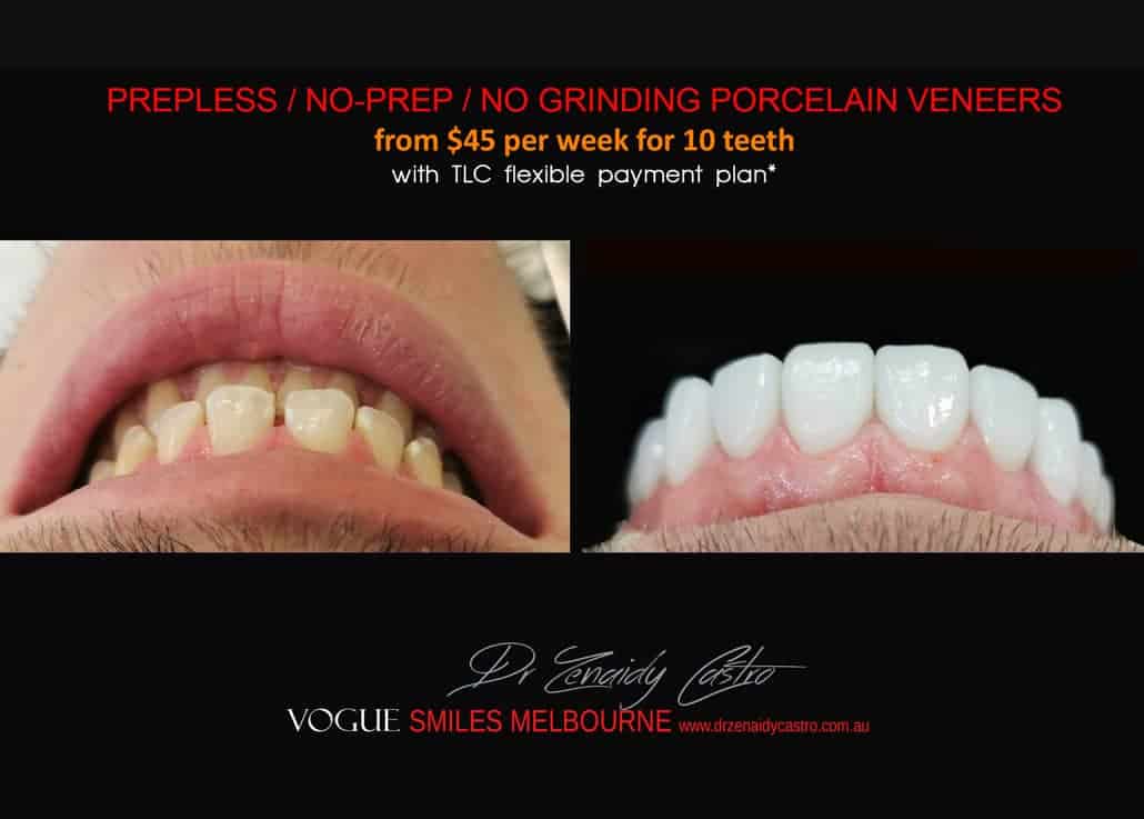 FULL SETS OF PORCELAIN VENEER COST PRICE IN MELBOURNE CBD - COSMETIC DENTIST COST VENEER