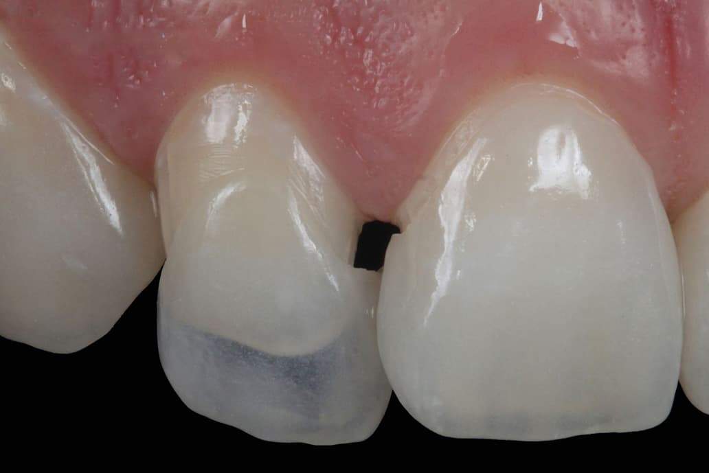 N0-PREP Porcelain Veneers - Dental Veneers without grinding teeth Melbourne