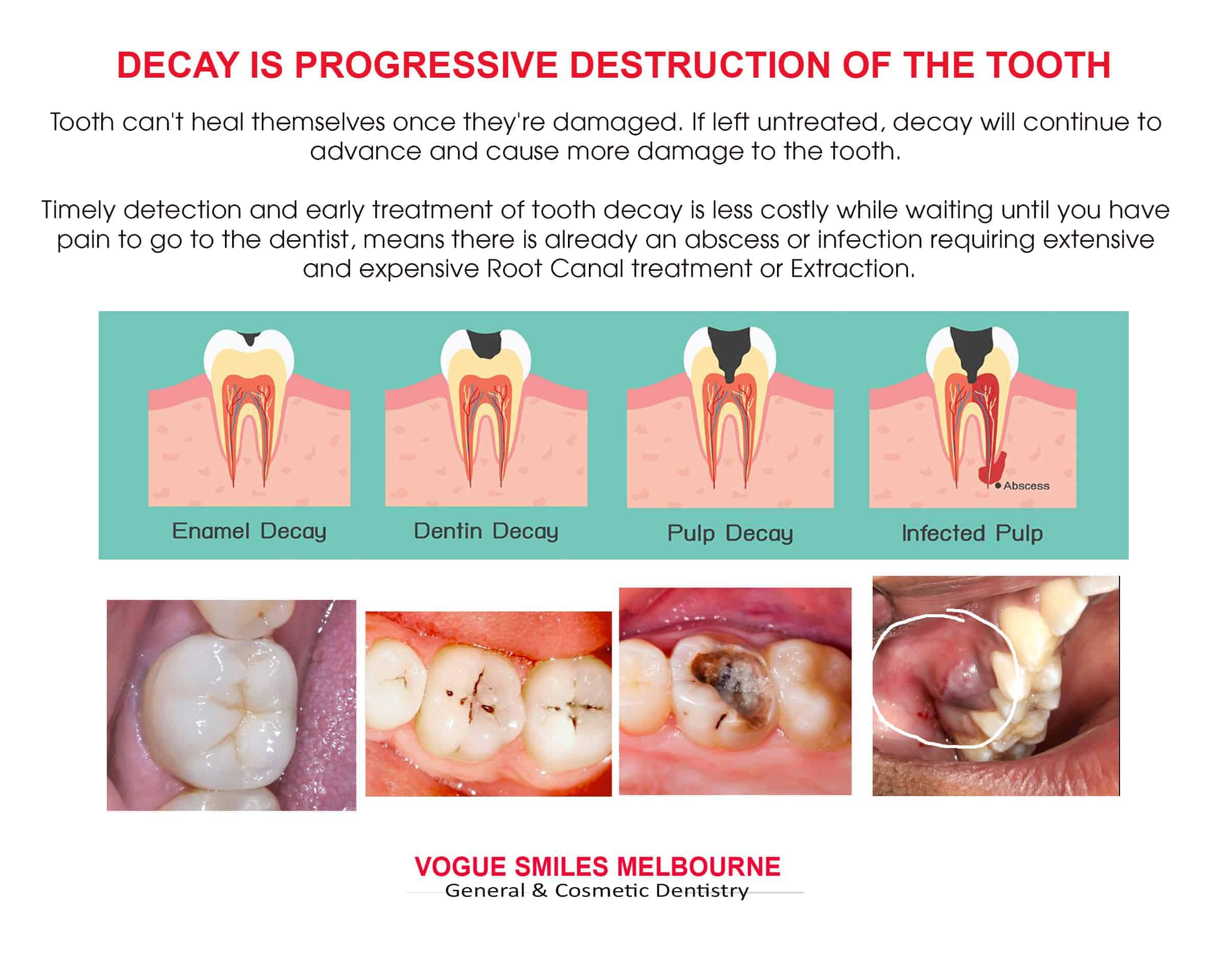 Tooth Decay Treatment Melbourne CBD - Best General Dentist in Melbourne CBD