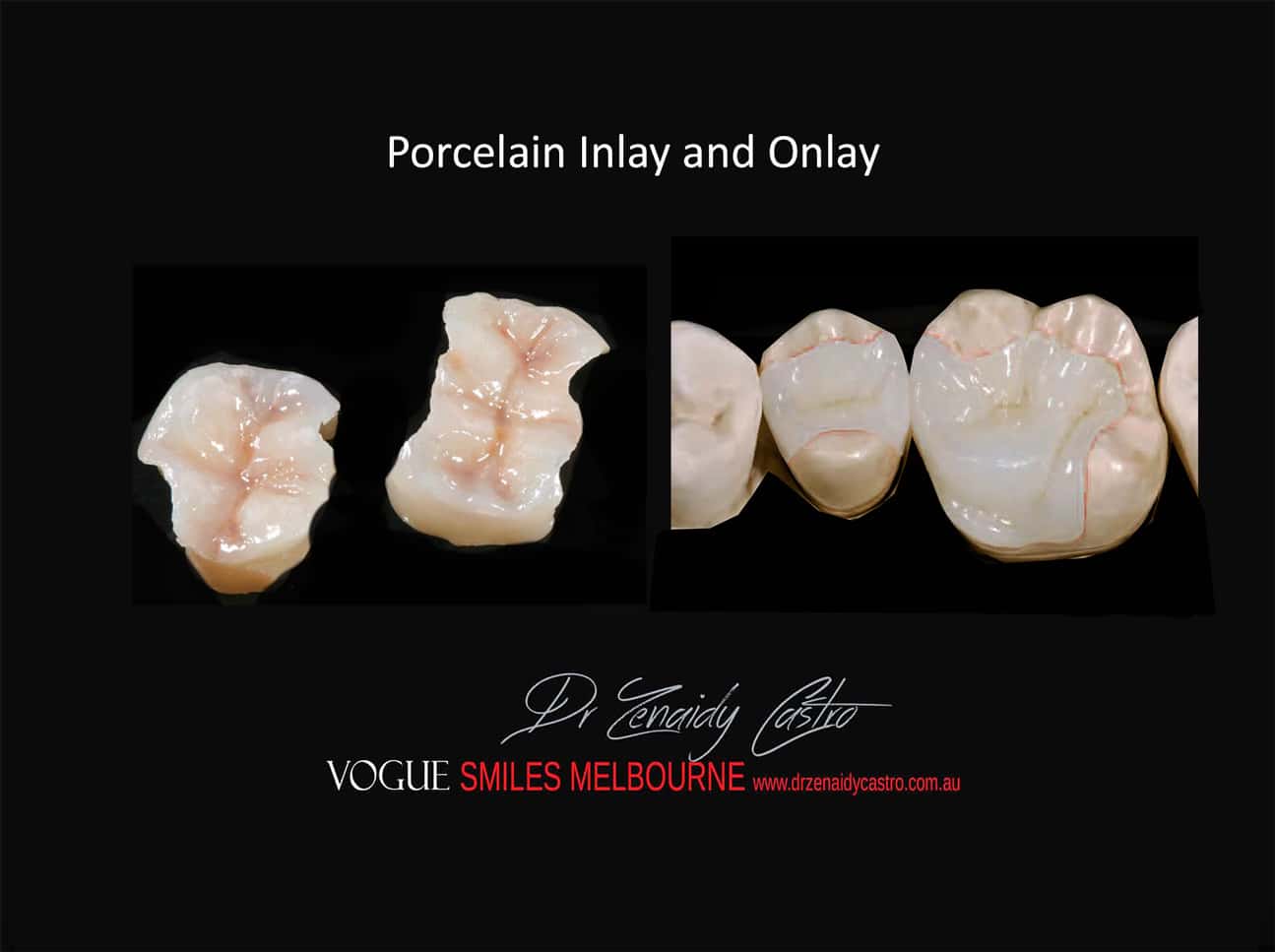 Porcelain Tooth Inlay and Onlay - Ceramic Tooth Fillings Melbourne -Best Dentist in Melbourne online reviews