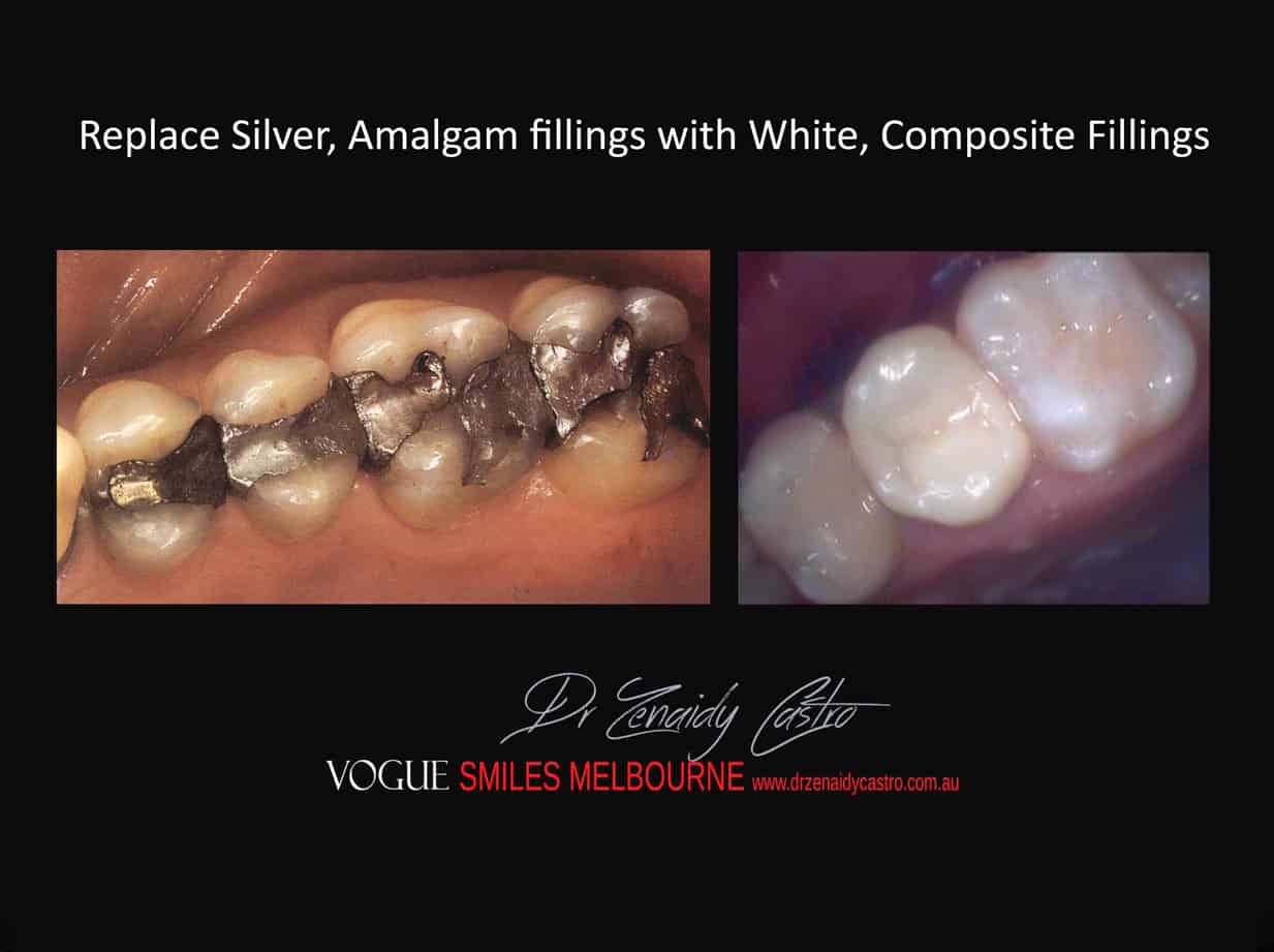 Replace Silver fillings with White, Composite Fillings Melbourne - Dentist Melbourne CBD