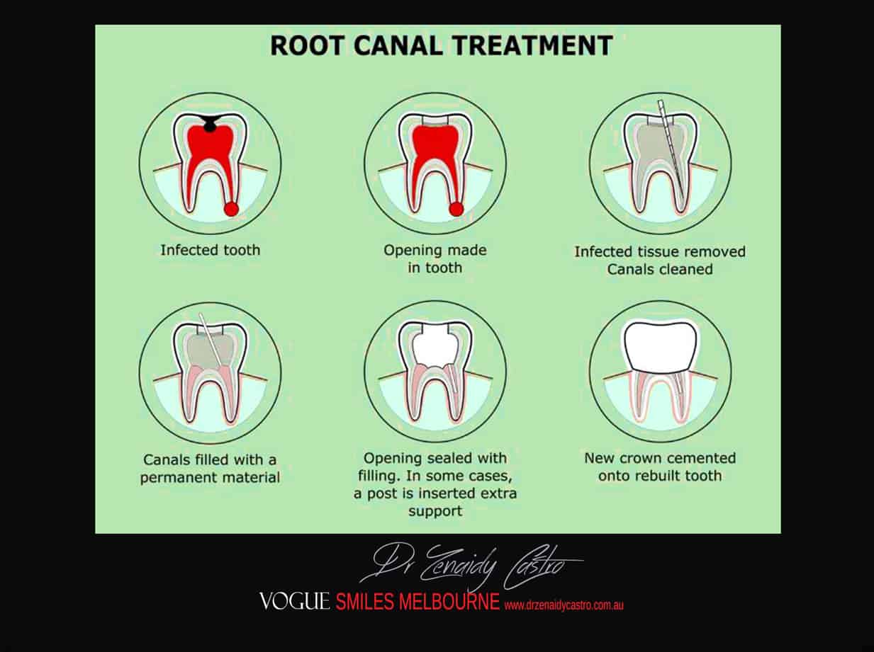Root Canal Treatment Melbourne CBD - Toothache Treatment Dentist Melbourne CBD