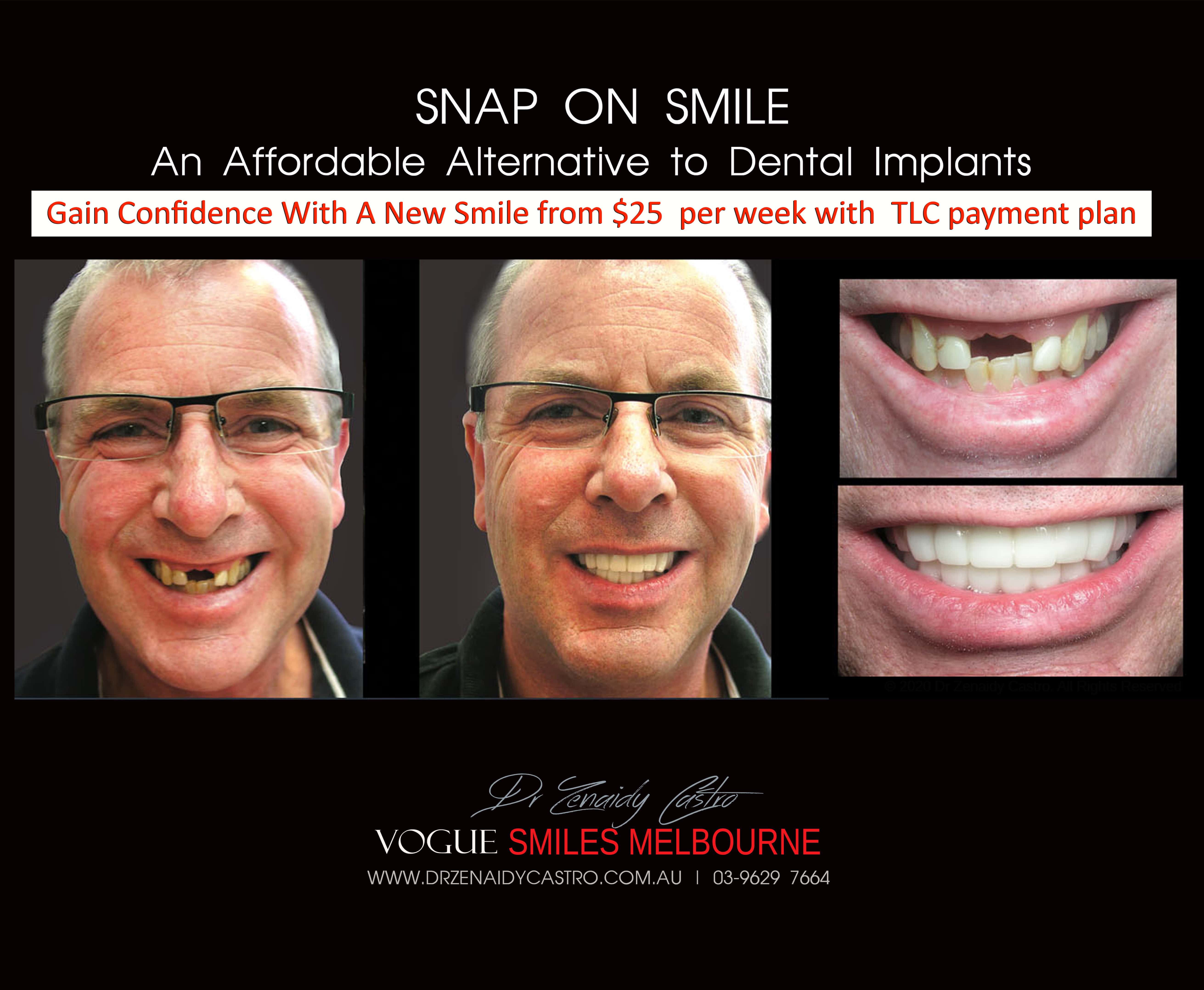 Cheaper alternative to Dental Implants, All-on 4 implants & Bridges in replacing missing teeth with Snap-on Smile Melbourne CBD- Cheap affordable Cosmetic Dentistry in Melbourne Victoria Australia