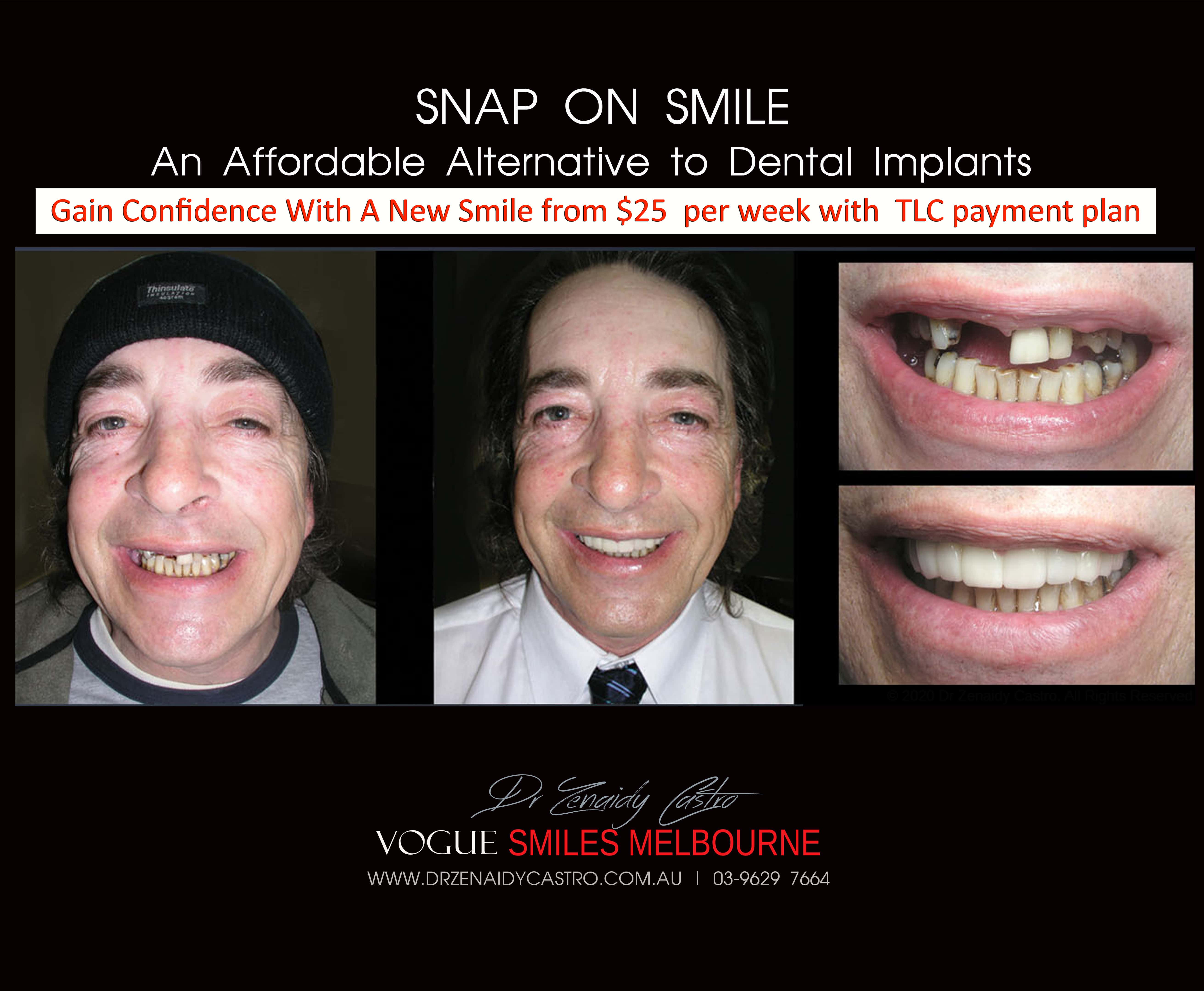 Cheaper alternative to Dental Implants, All-on 4 implants & Bridges in replacing missing teeth with Snap-on Smile Melbourne CBD- Cheap affordable Cosmetic Dentistry in Melbourne Victoria Australia