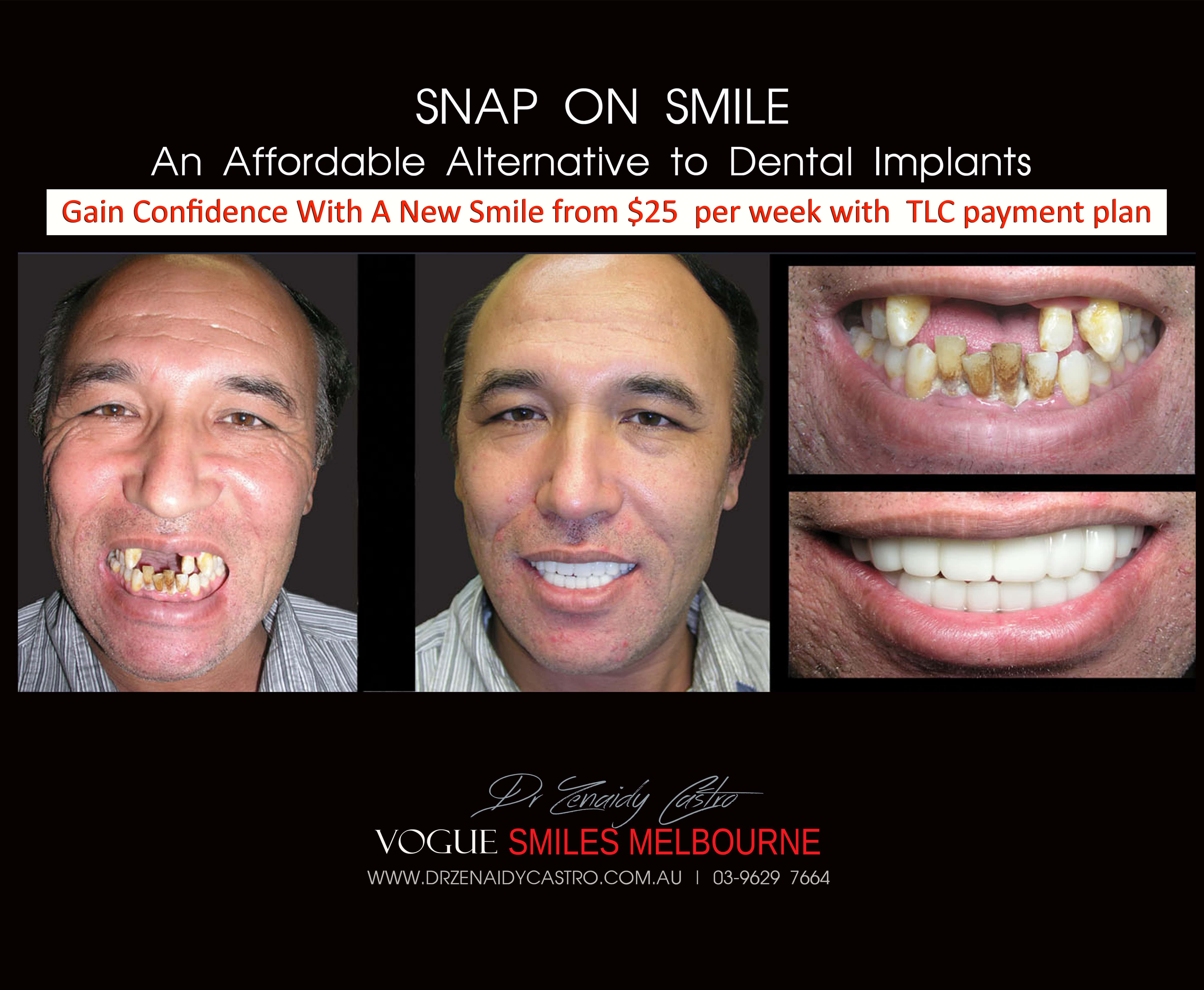 Cheaper alternative to Dental Implants, All-on 4 implants & Bridges in replacing missing teeth with Snap-on Smile Melbourne CBD- Cheap affordable Cosmetic Dentistry in Melbourne Victoria Australia