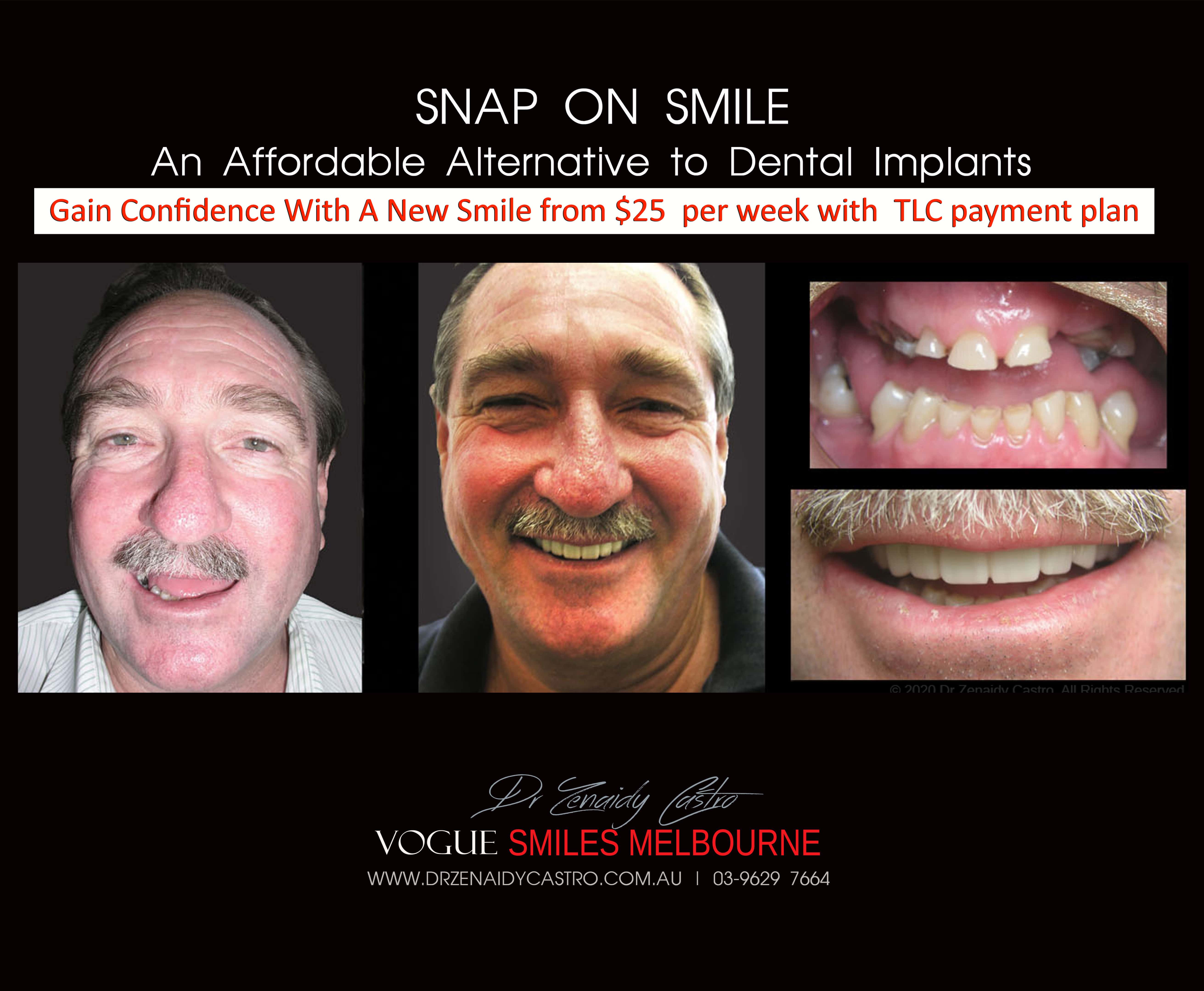 Cheaper alternative to Dental Implants, All-on 4 implants & Bridges in replacing missing teeth with Snap-on Smile Melbourne CBD- Cheap affordable Cosmetic Dentistry in Melbourne Victoria Australia