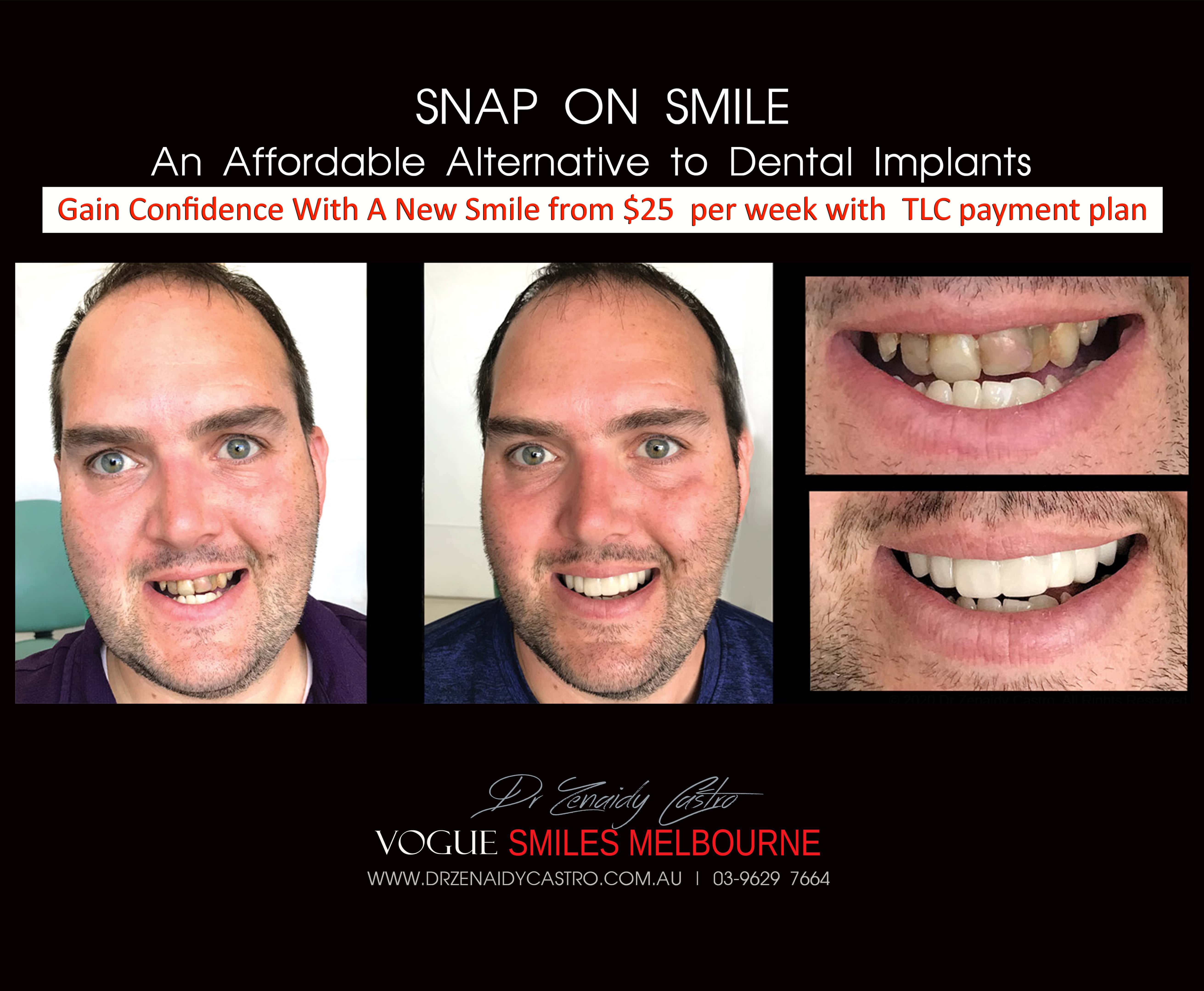 Cheaper alternative to Dental Implants, All-on 4 implants & Bridges in replacing missing teeth with Snap-on Smile Melbourne CBD- Cheap affordable Cosmetic Dentistry in Melbourne Victoria Australia