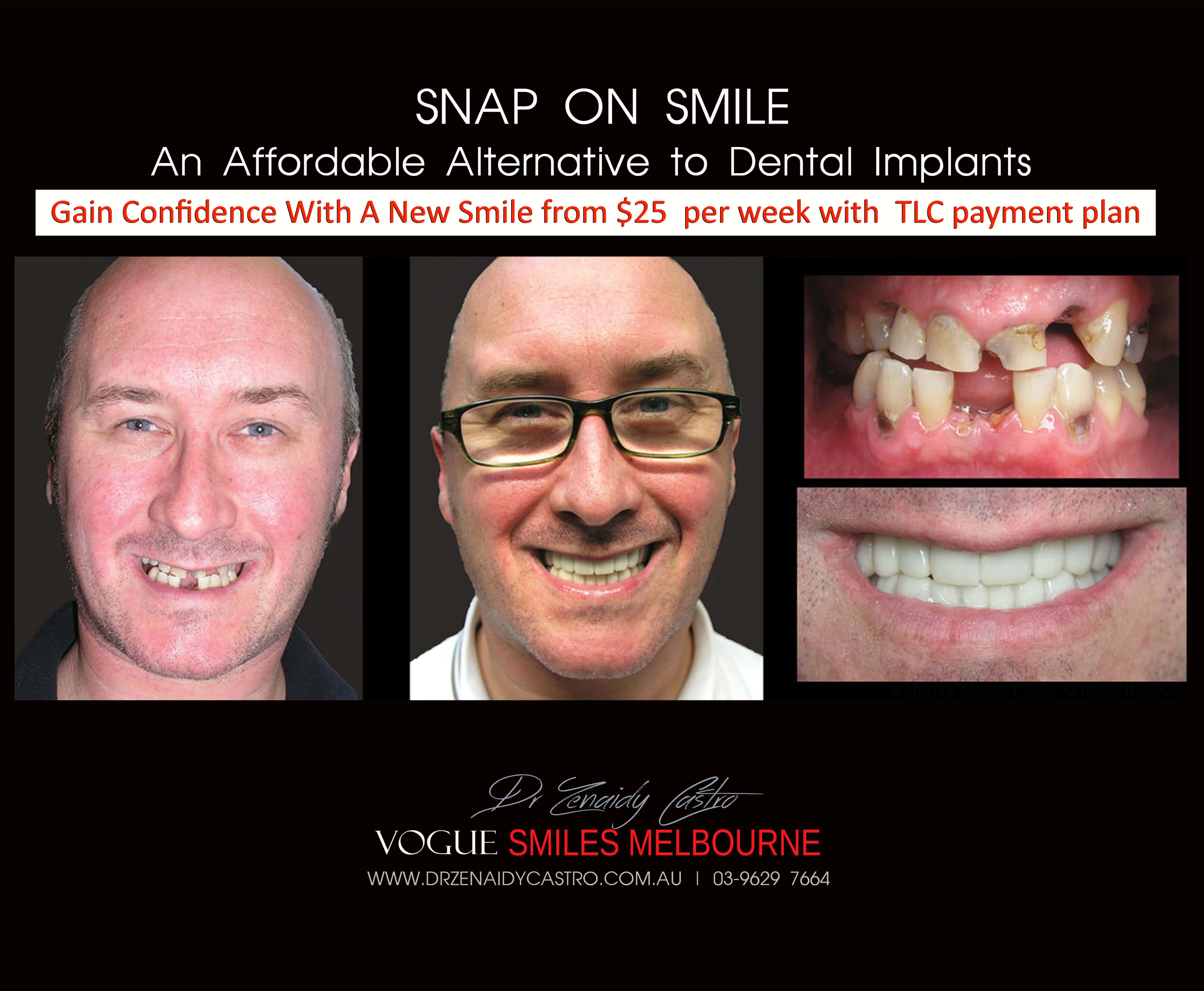 Cheaper alternative to Dental Implants, All-on 4 implants & Bridges in replacing missing teeth with Snap-on Smile Melbourne CBD- Cheap affordable Cosmetic Dentistry in Melbourne Victoria Australia