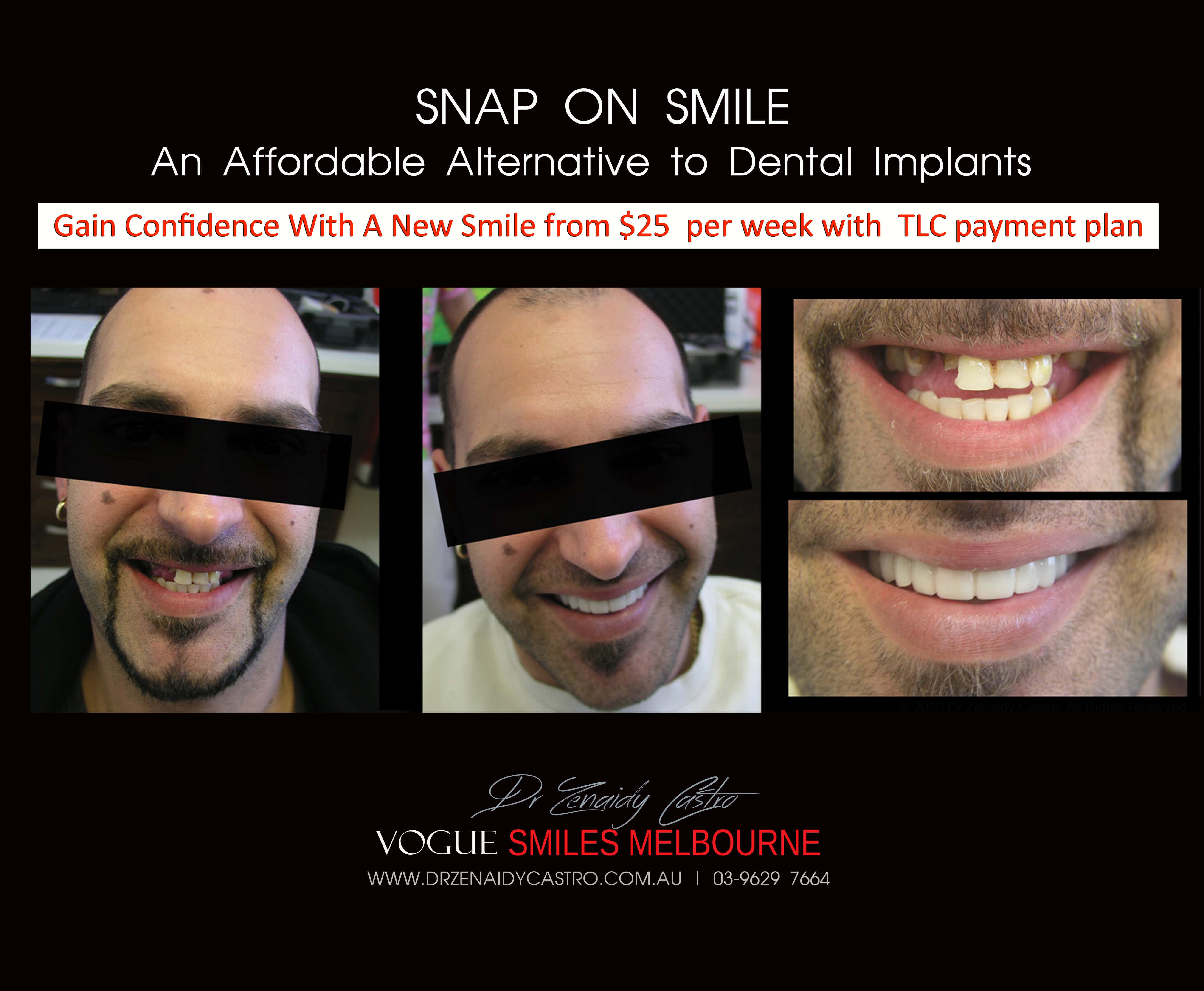 Cheaper alternative to Dental Implants, All-on 4 implants & Bridges in replacing missing teeth with Snap-on Smile Melbourne CBD- Cheap affordable Cosmetic Dentistry in Melbourne Victoria Australia