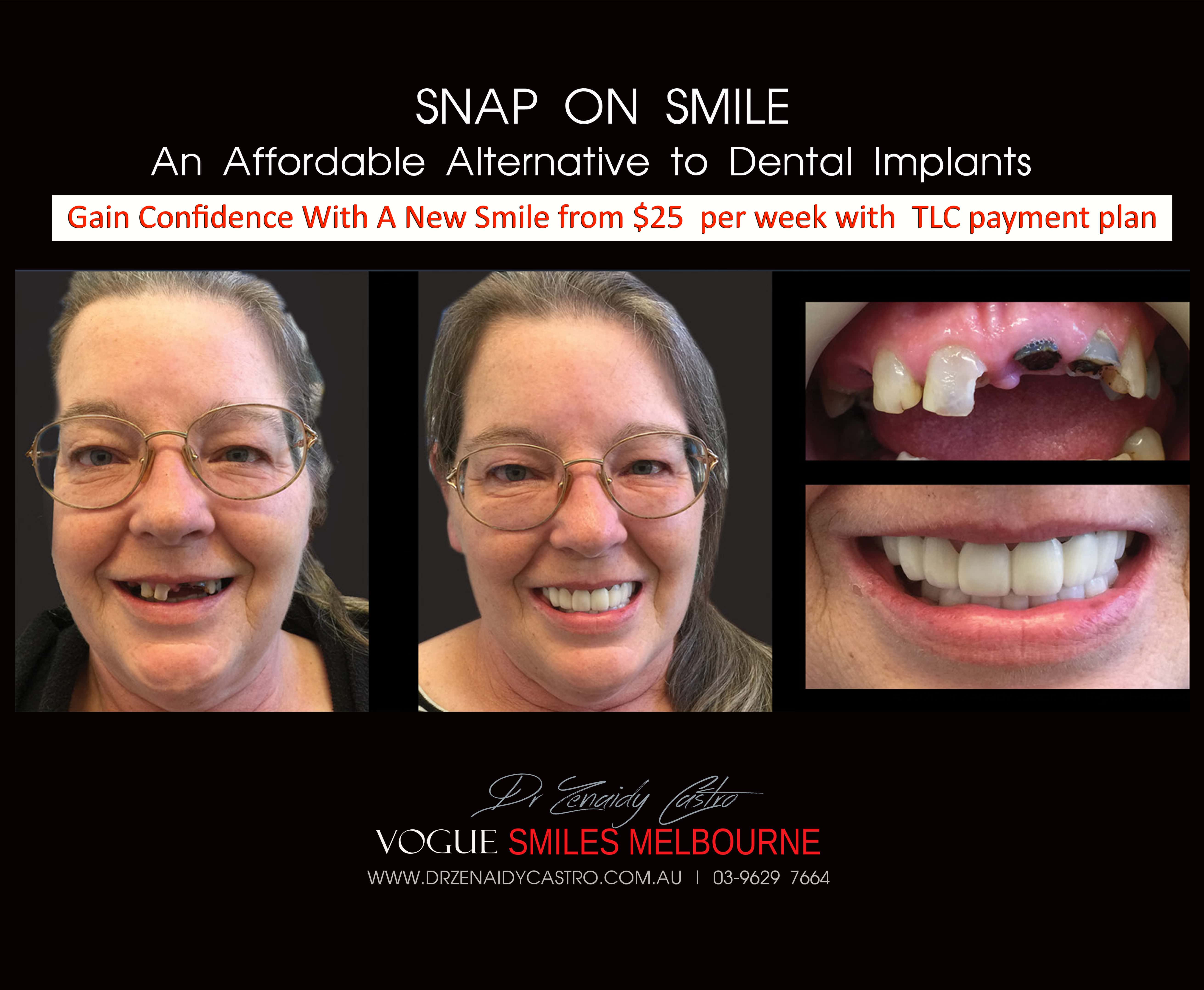 Cheaper alternative to Dental Implants, All-on 4 implants & Bridges in replacing missing teeth with Snap-on Smile Melbourne CBD- Cheap affordable Cosmetic Dentistry in Melbourne Victoria Australia