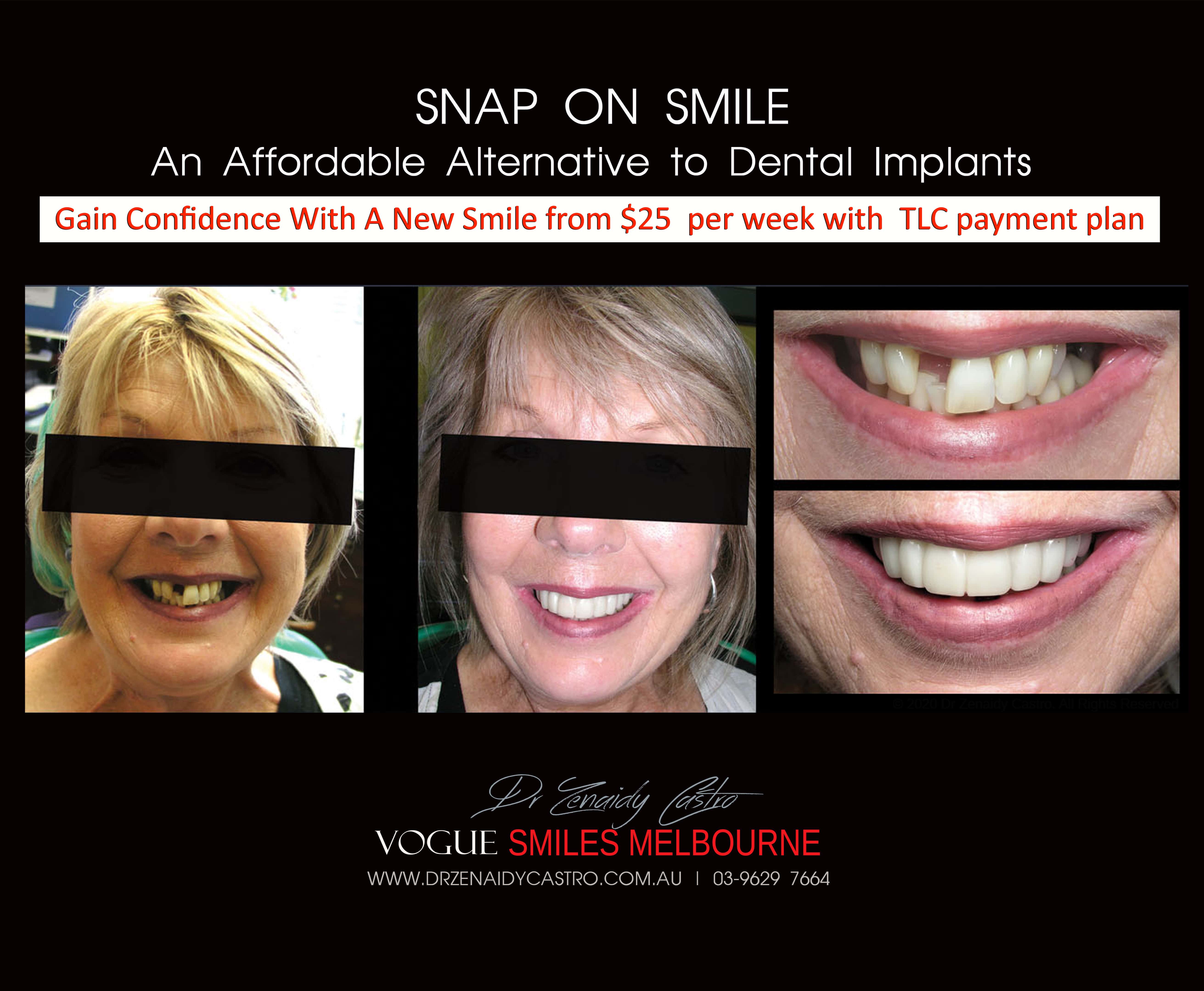 Cheaper alternative to Dental Implants, All-on 4 implants & Bridges in replacing missing teeth with Snap-on Smile Melbourne CBD- Cheap affordable Cosmetic Dentistry in Melbourne Victoria Australia