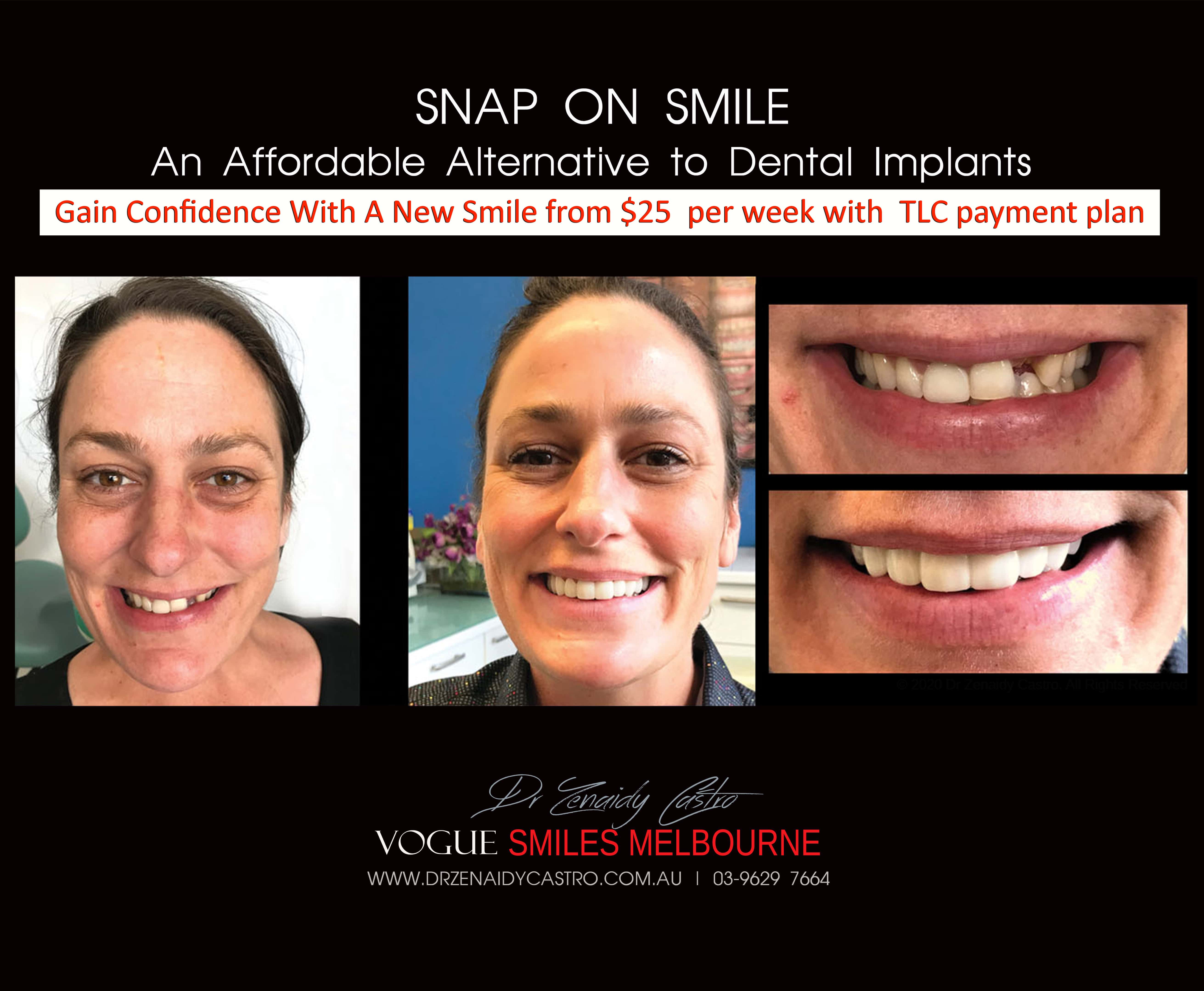 Cheaper alternative to Dental Implants, All-on 4 implants & Bridges in replacing missing teeth with Snap-on Smile Melbourne CBD- Cheap affordable Cosmetic Dentistry in Melbourne Victoria Australia