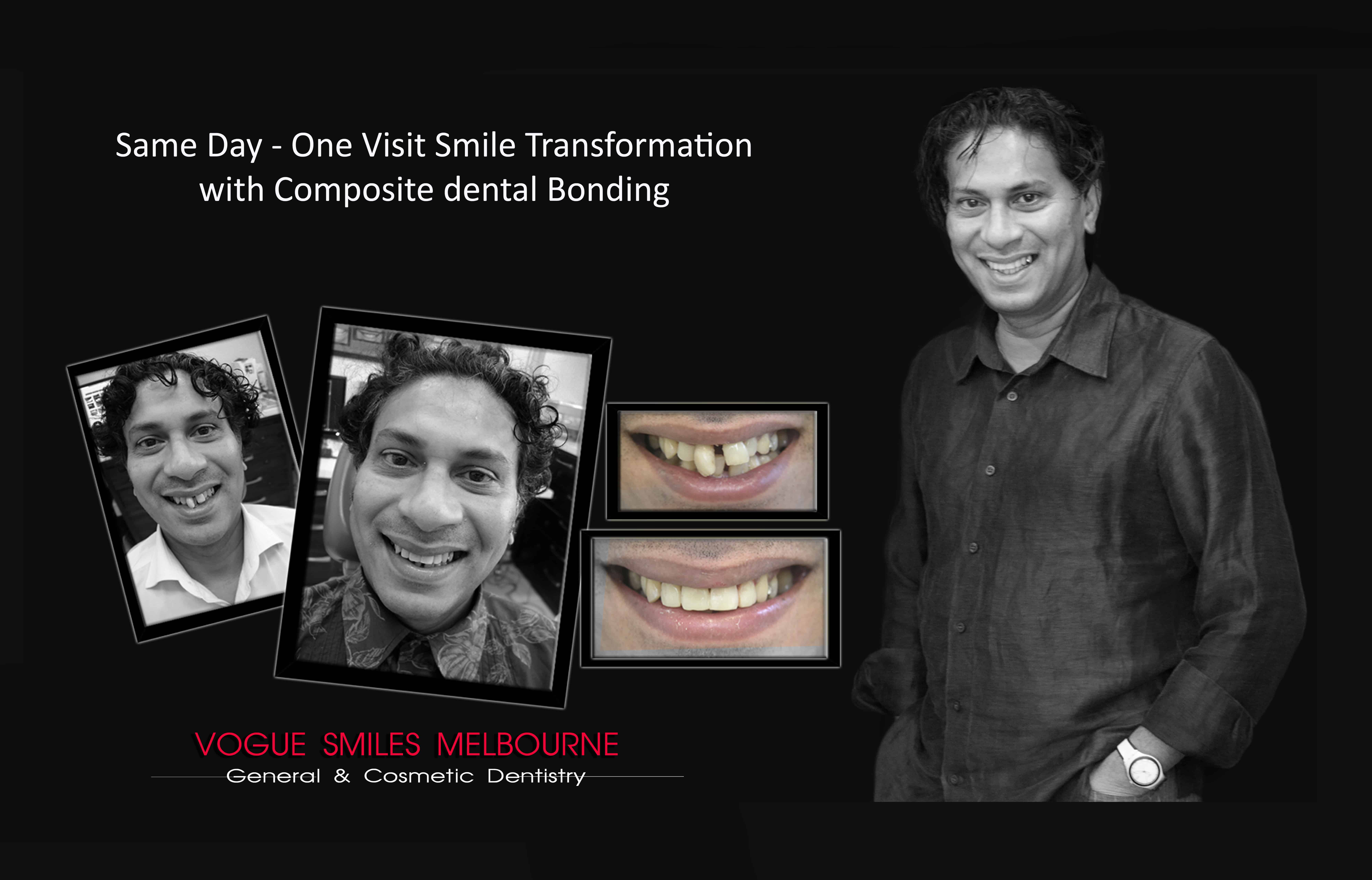 TRANSITIONAL SMILE MAKEOVER Melbourne CBD, Intermediate Cheapest most affordable Cosmetic Dentistry option to improve smile Melbourne Victoria Australia - Cosmetic Dentist Melbourne