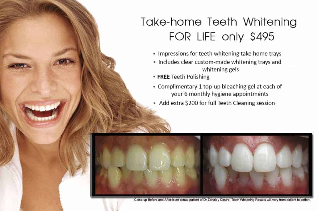 At-home Teeth Whitening Kits or Take-Home Whitening Melbourne CBD -affordable teeth whitening in Melbourne