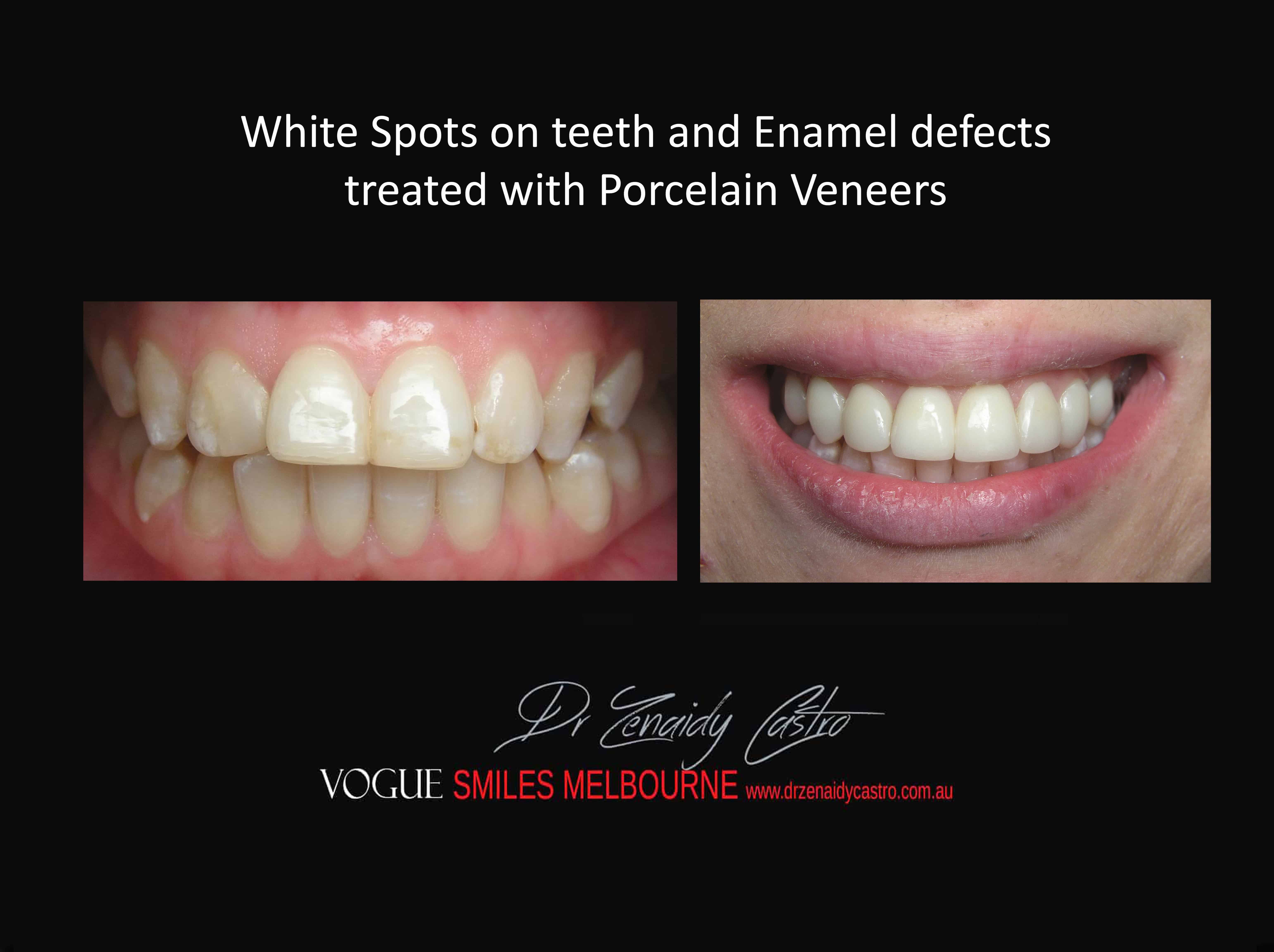 White Spots on Teeth and Enamel Defect Treatment Melbourne, Remove Tooth Discolouration Melbourne, Hypoplastic Teeth Melbourne CBD Victoria Australia