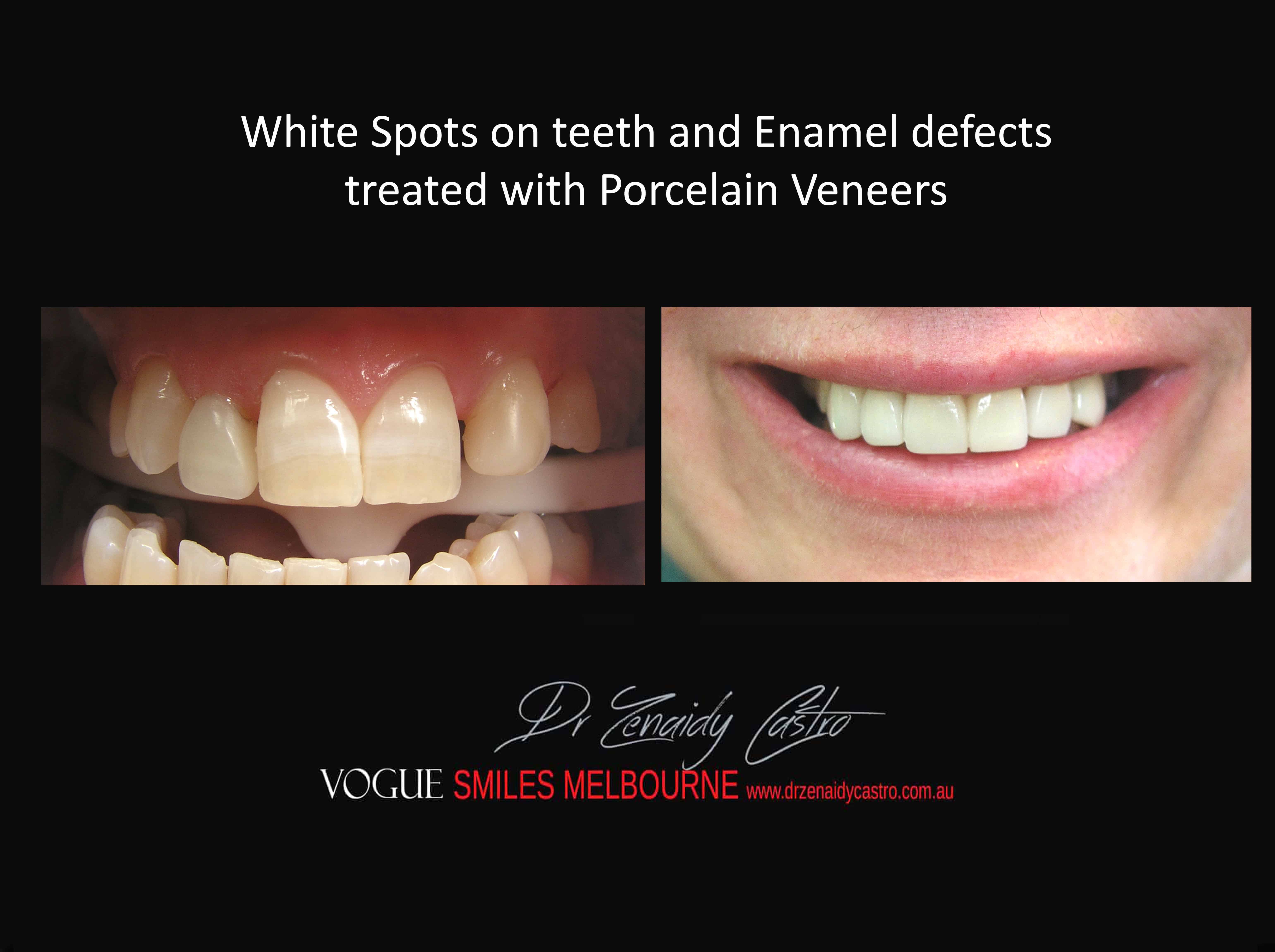 White Spots on Teeth and Enamel Defect Treatment Melbourne, Remove Tooth Discolouration Melbourne, Hypoplastic Teeth Melbourne CBD Victoria Australia