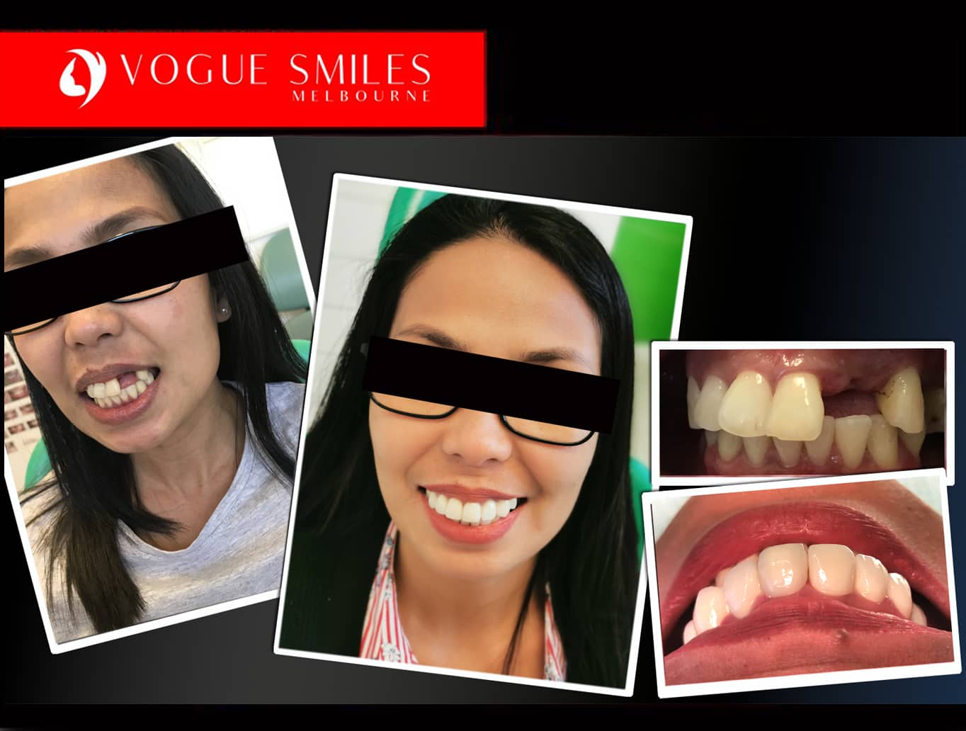 Full and Partial Dentures, False Teeth Options & Costs Melbourne CBD Dentist