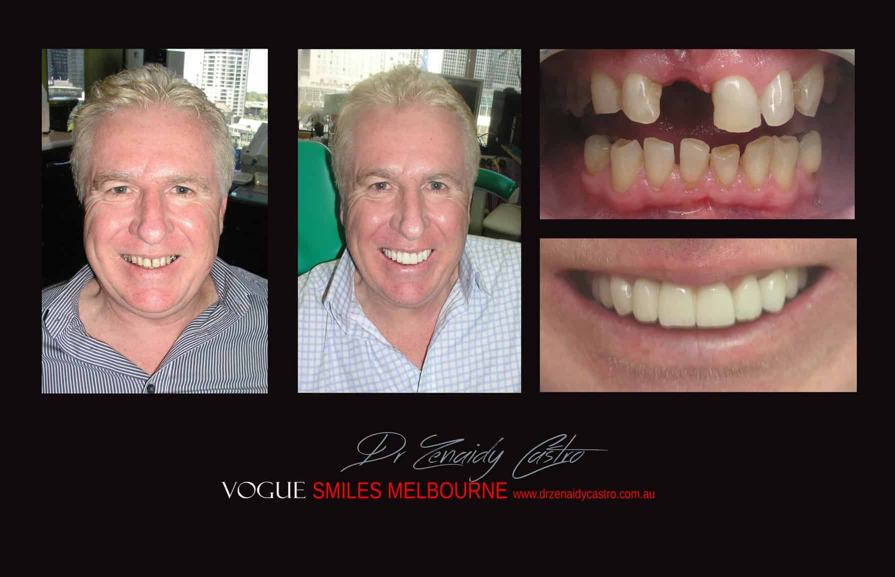 Smile Makeover Procedures Melbourne CBD Victoria Australia - Best Dentist Melbourne - Dr Zenaidy Castro - VOGUE SMILES MELBOURNE