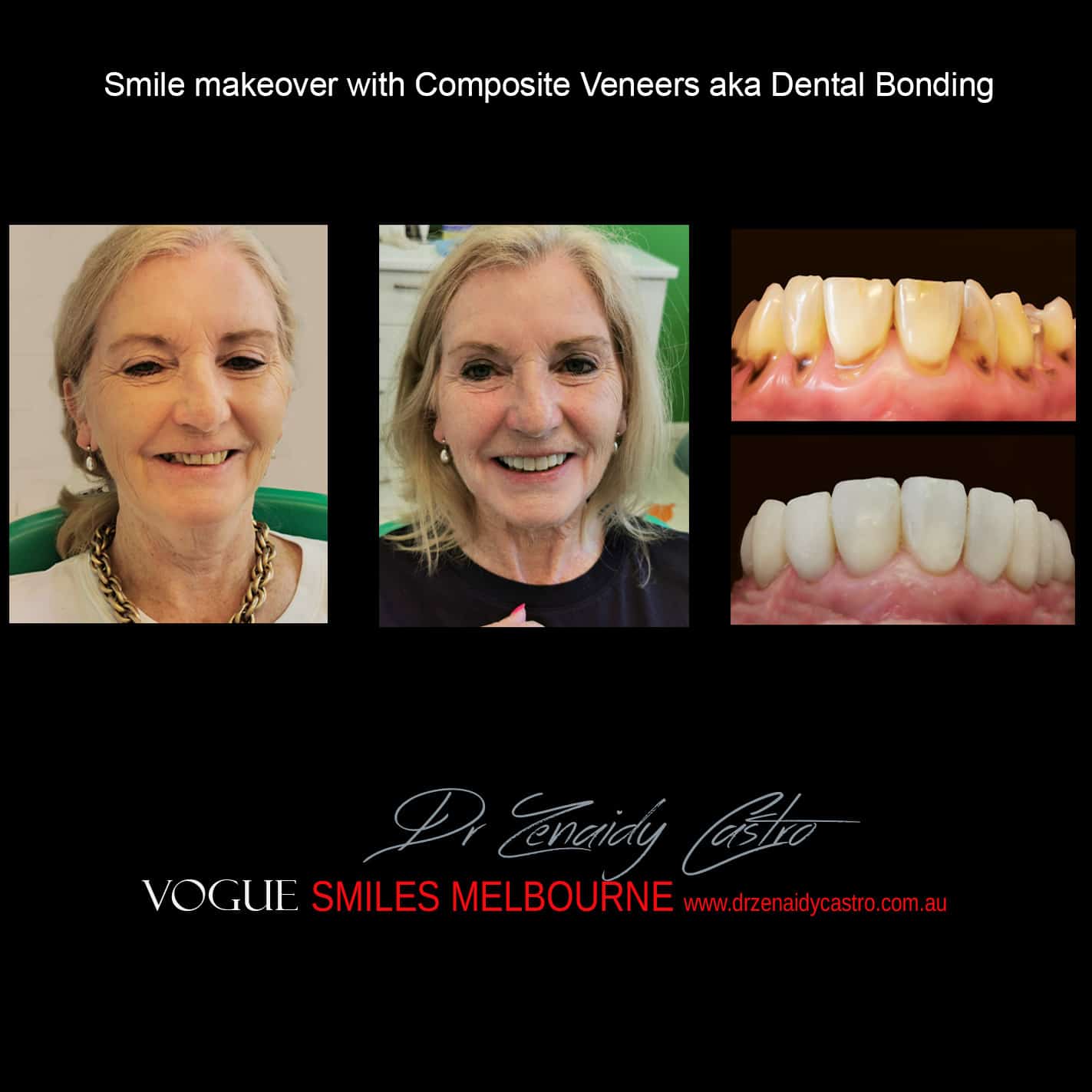 HOW MUCH DOES THE Cosmetic Dental Bonding or Composite Veneers COST IN MELBOURNE, Cost of Cosmetic Dental Bonding or Composite Veneers in Melbourne CBD?