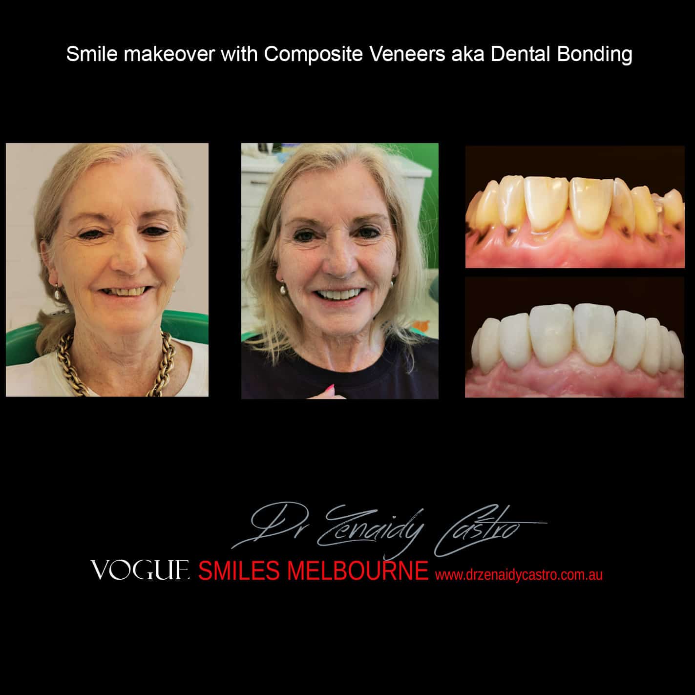 Smile Rejuvenation by Vogue Smiles Melbourne, rejuvenation clinic Melbourne, Non-surgical Facial Rejuvenation Melbourne, Anti Aging Treatment Melbourne